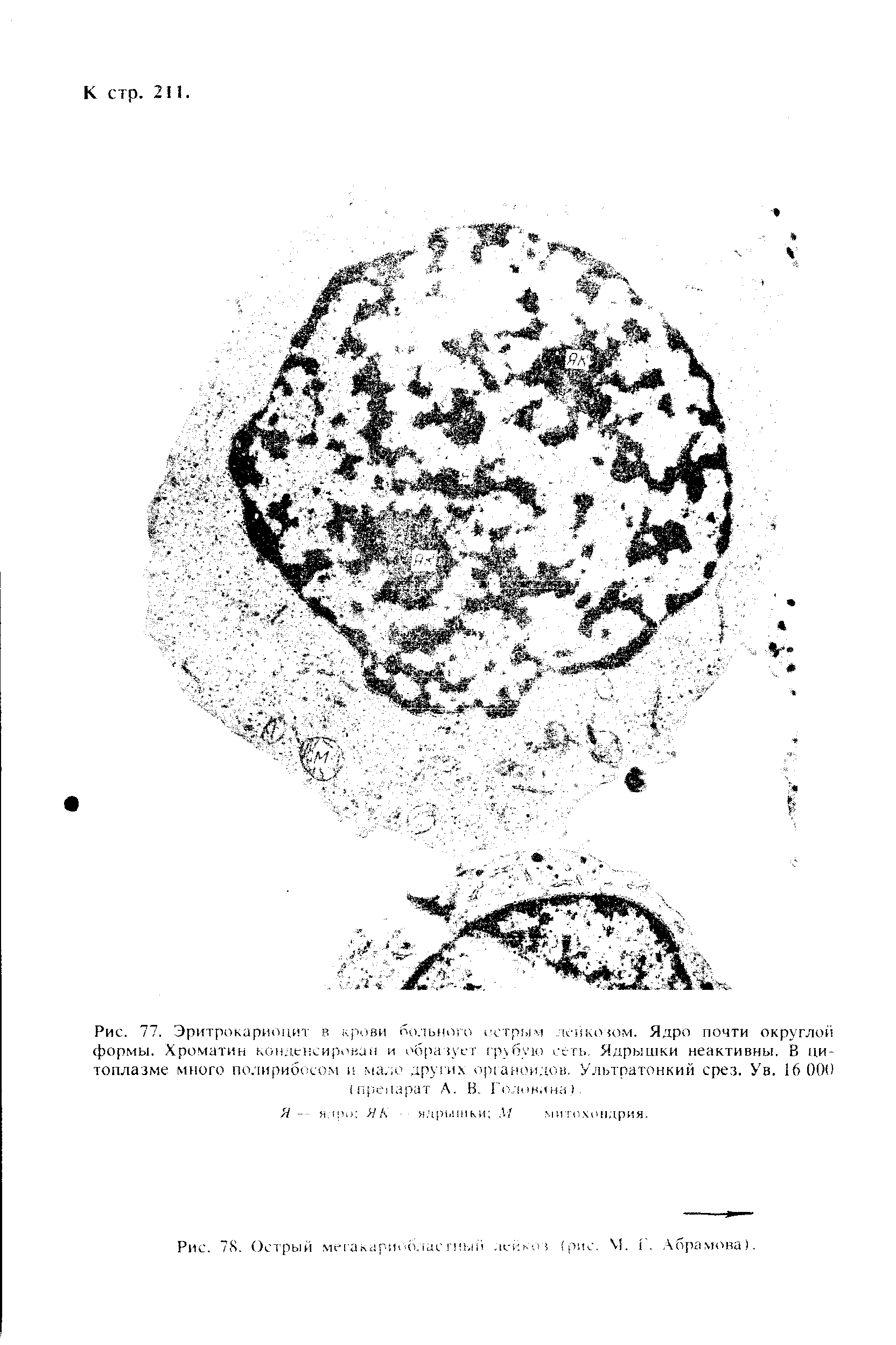 Рис. 77. Эритрокариоцит в крови больного острым лейкозом. Ядро почти округлой формы. Хроматин конденсирован и образует грубую сеть Ядрышки неактивны. В цитоплазме много полирибосо.м и мало других органоидов. Ультратонкий срез. Ув. 16 000 препарат А. В Головина. ...