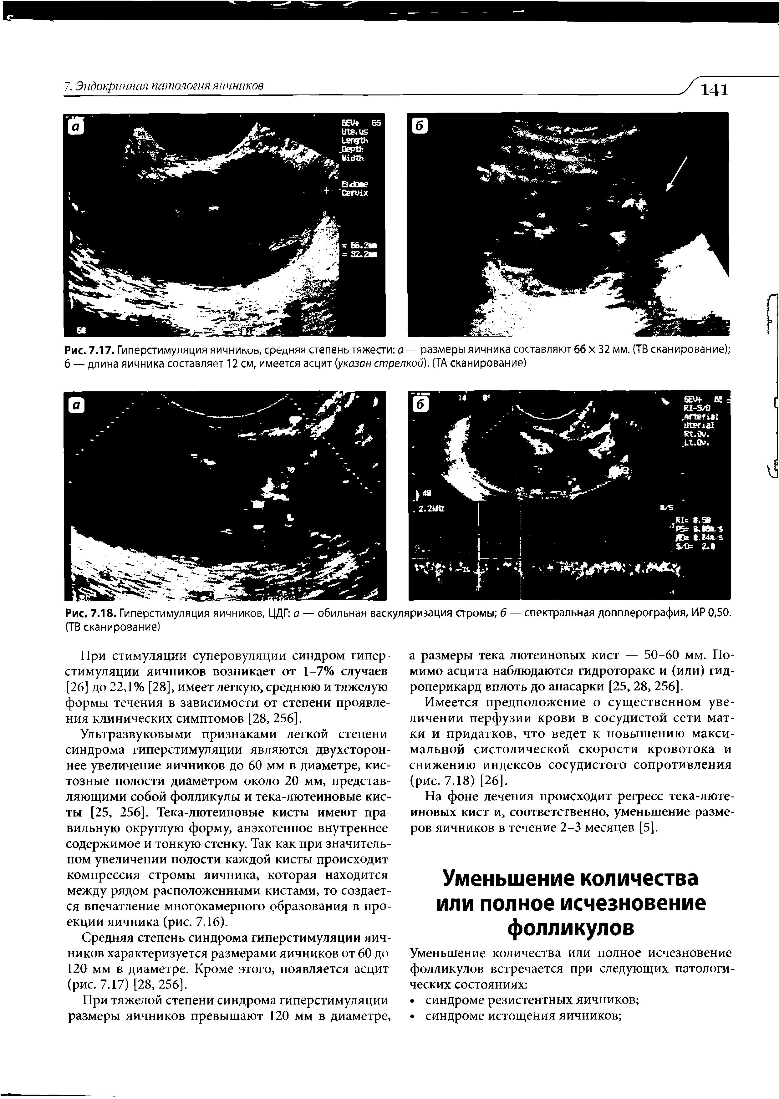 Рис. 7.17. Гиперстимуляция яичнилив, средняя степень тяжести а — размеры яичника составляют 66 х 32 мм. (ТВ сканирование) б — длина яичника составляет 12 см, имеется асцит (указан стрелкой). (ТА сканирование)...