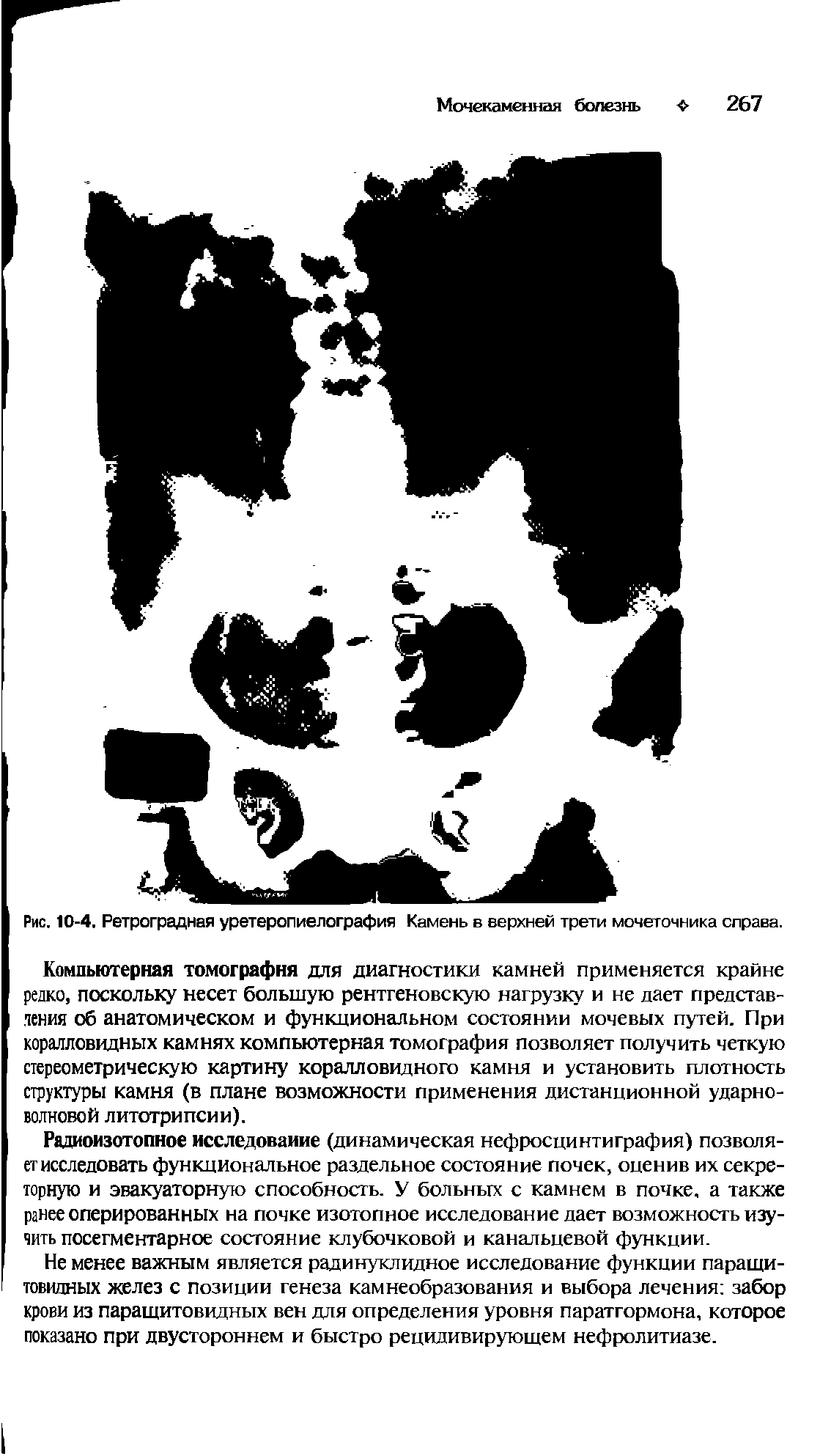 Рис. 10-4. Ретроградная уретеропиелография Камень в верхней трети мочеточника справа.