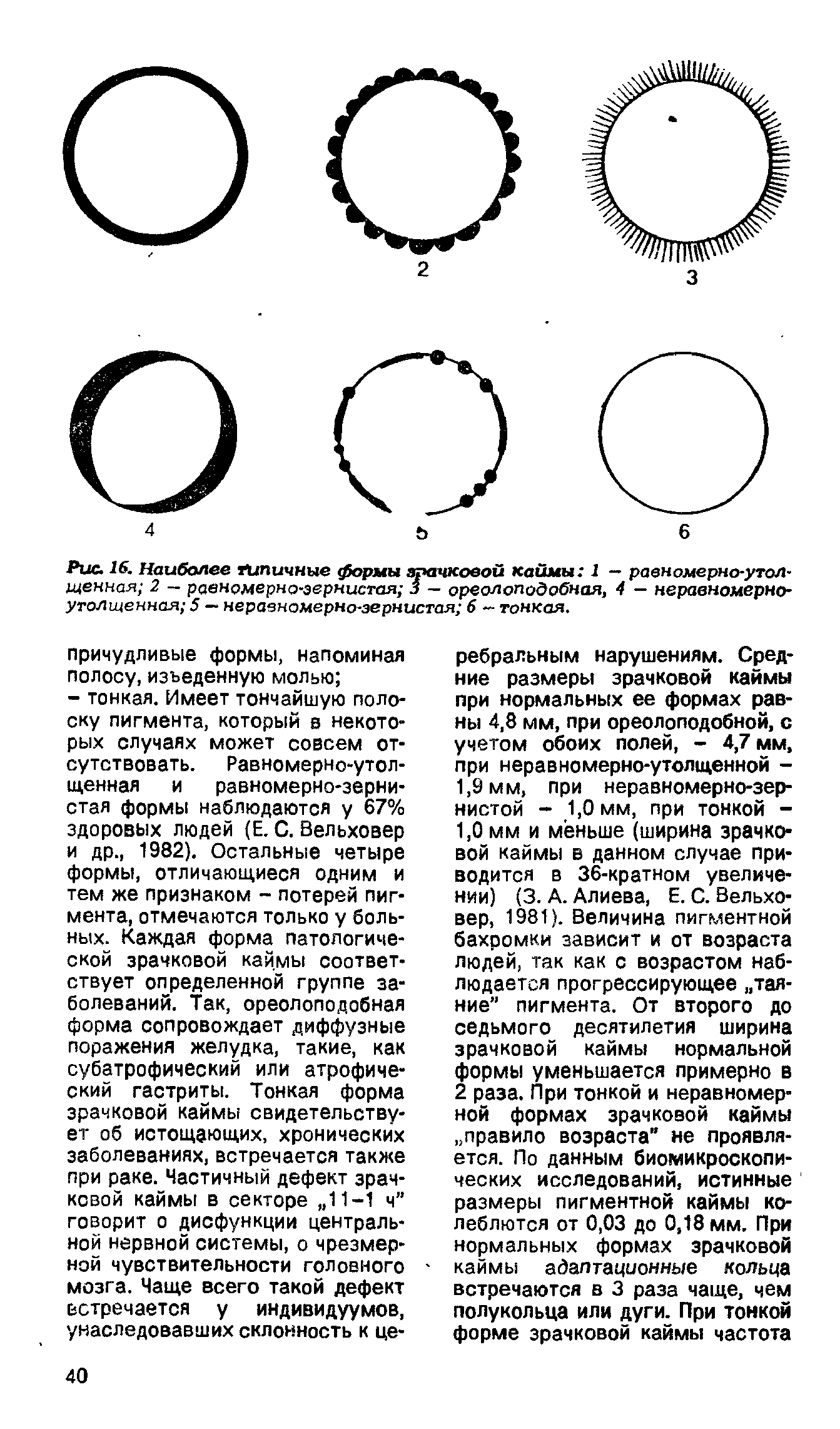 Рис. 16. Наиболее типичные формы зрачковой каймы 1 — равномерно-утолщенная 2 — равномерно-зернистая 3 - ореолоподобная, 4 - неравномерноутолщенная 5 — неравномерно-зернистая 6 — тонкая.