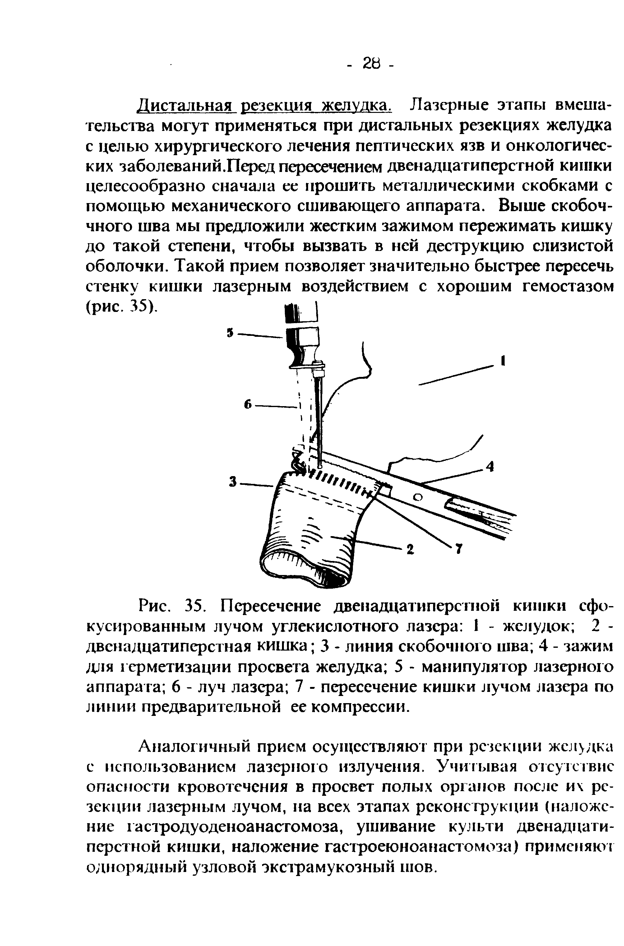 Рис. 35. Пересечение двенадцатиперстной кишки сфокусированным лучом углекислотного лазера 1 - желудок 2 -двенадцатиперстная кишка 3 - линия скобочного шва 4 - зажим для герметизации просвета желудка 5 - манипулятор лазерного аппарата 6 - луч лазера 7 - пересечение кишки лучом лазера по линии предварительной ее компрессии.