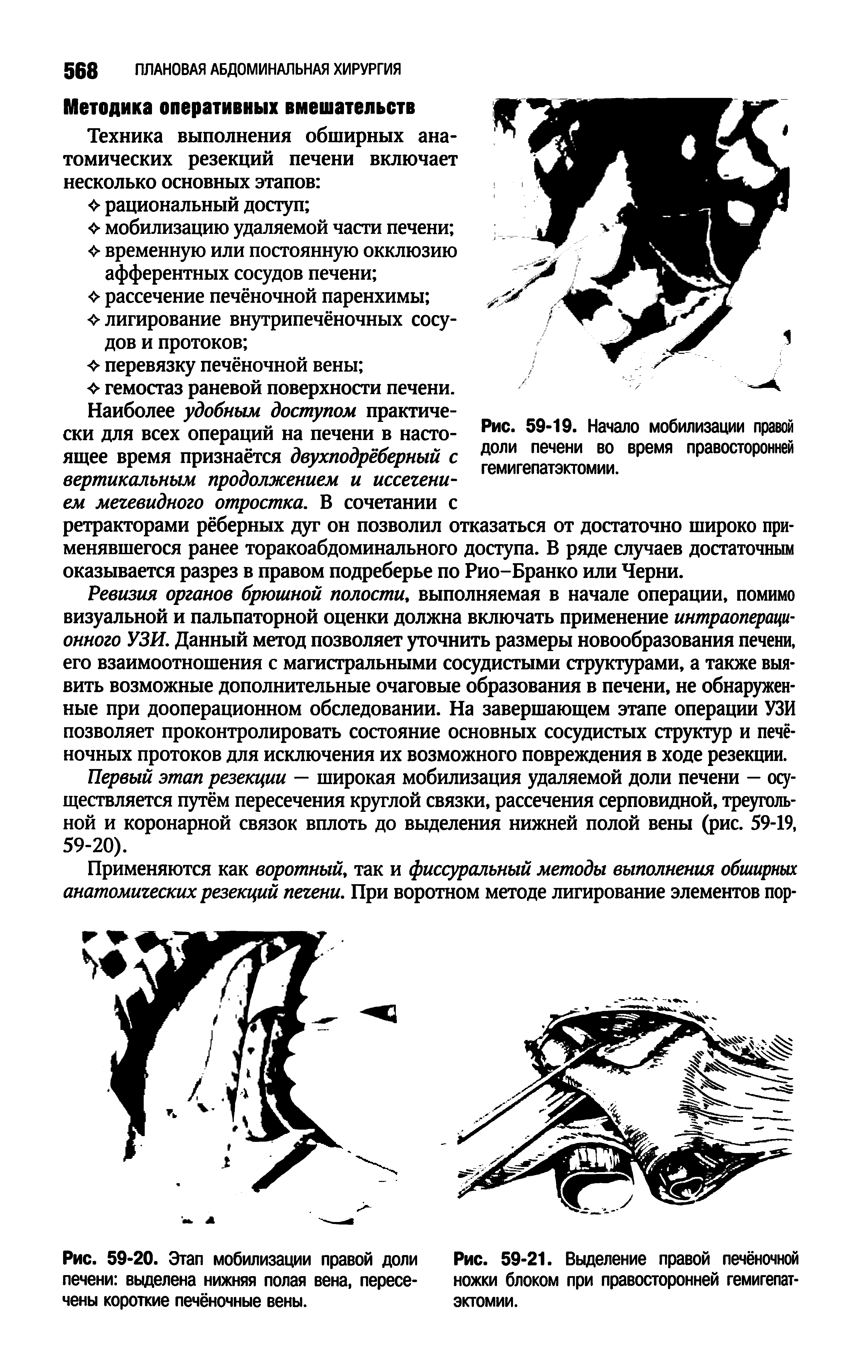 Рис. 59-20. Этап мобилизации правой доли печени выделена нижняя полая вена, пересечены короткие печёночные вены.