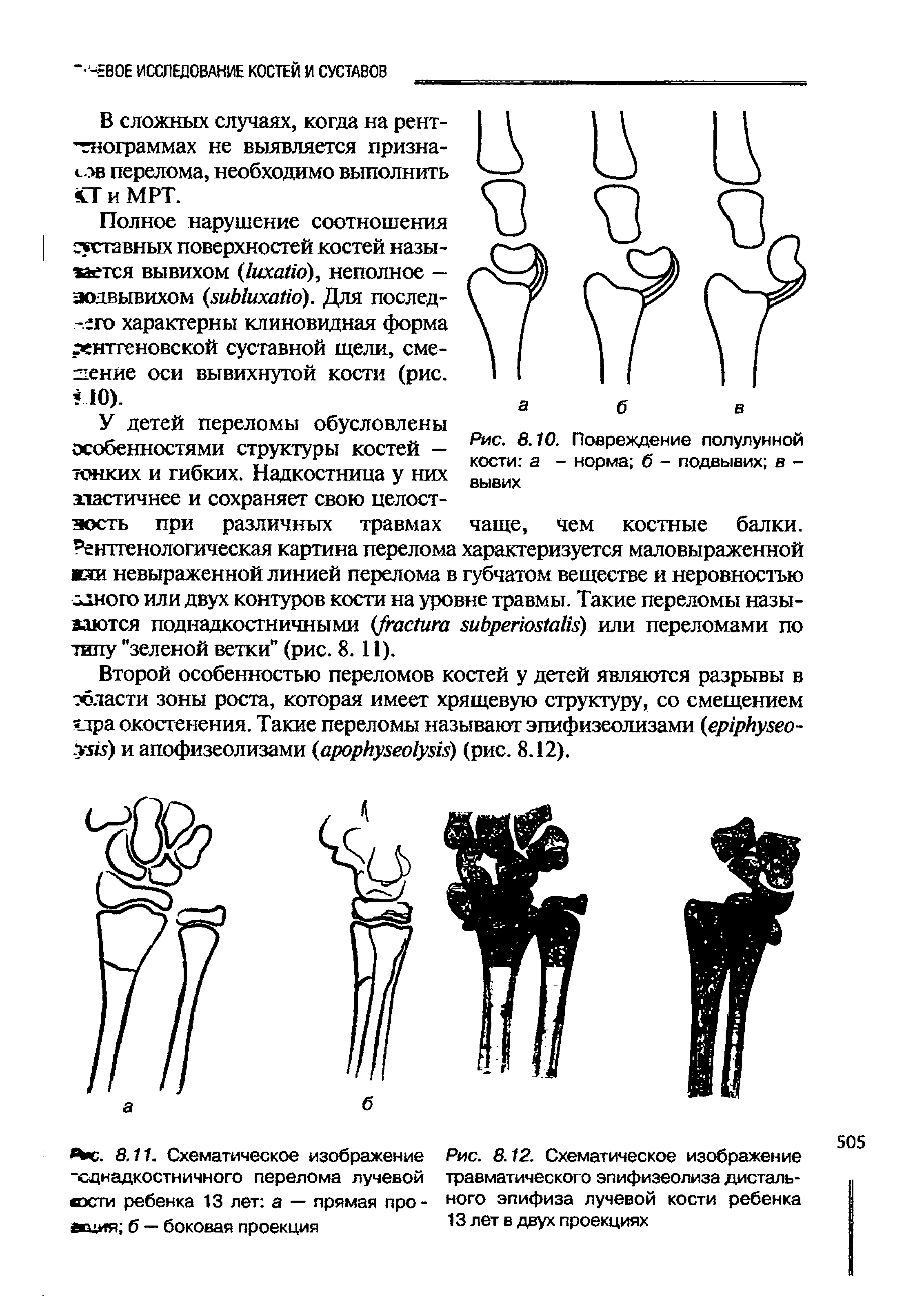 Рис. 8.12. Схематическое изображение травматического эпифизеолиза дистального эпифиза лучевой кости ребенка 13 лет в двух проекциях...