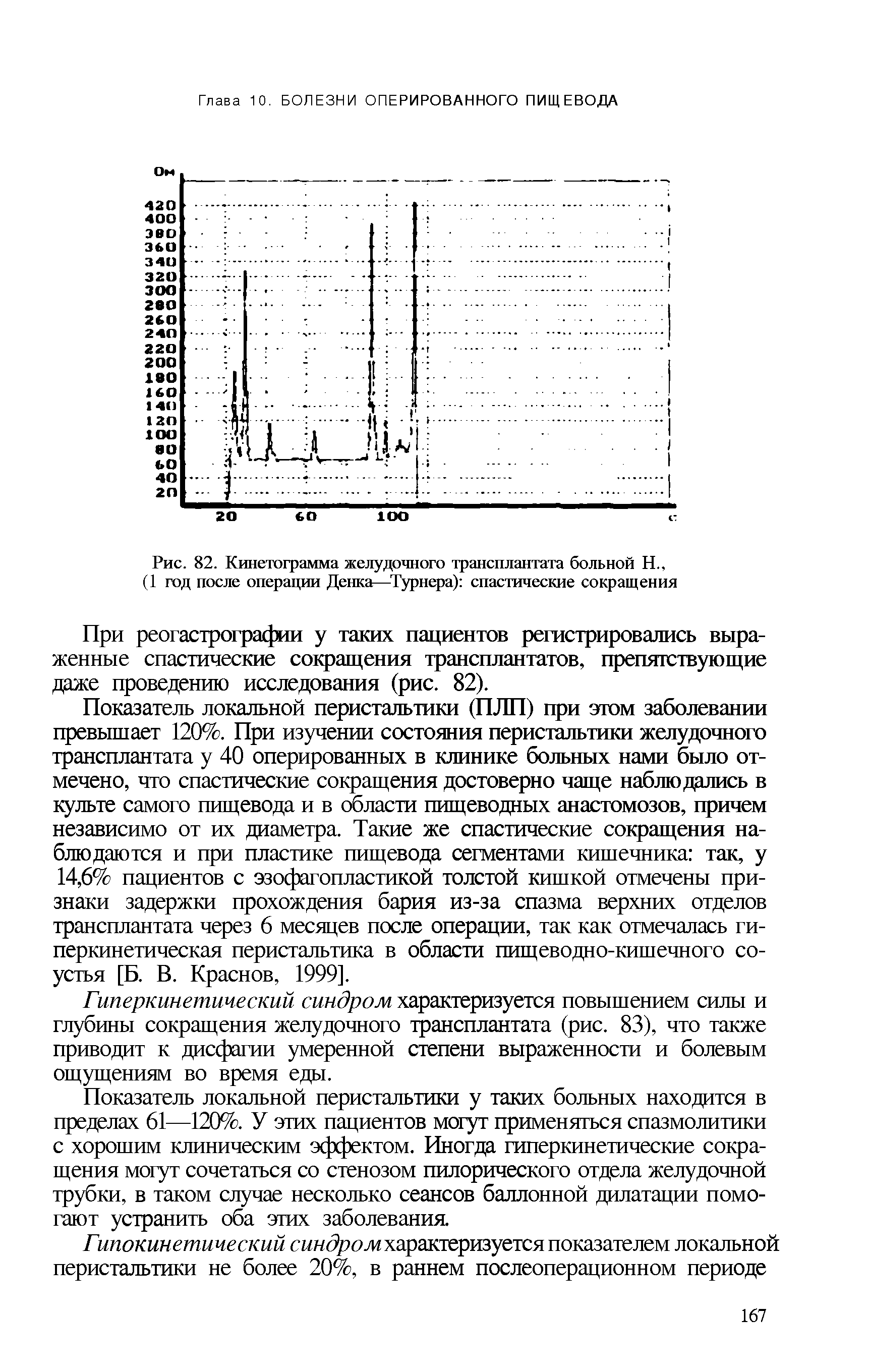 Рис. 82. Кинетограмма желудочного трансплантата больной Н., (1 год после операции Денка—Турнера) спастические сокращения...