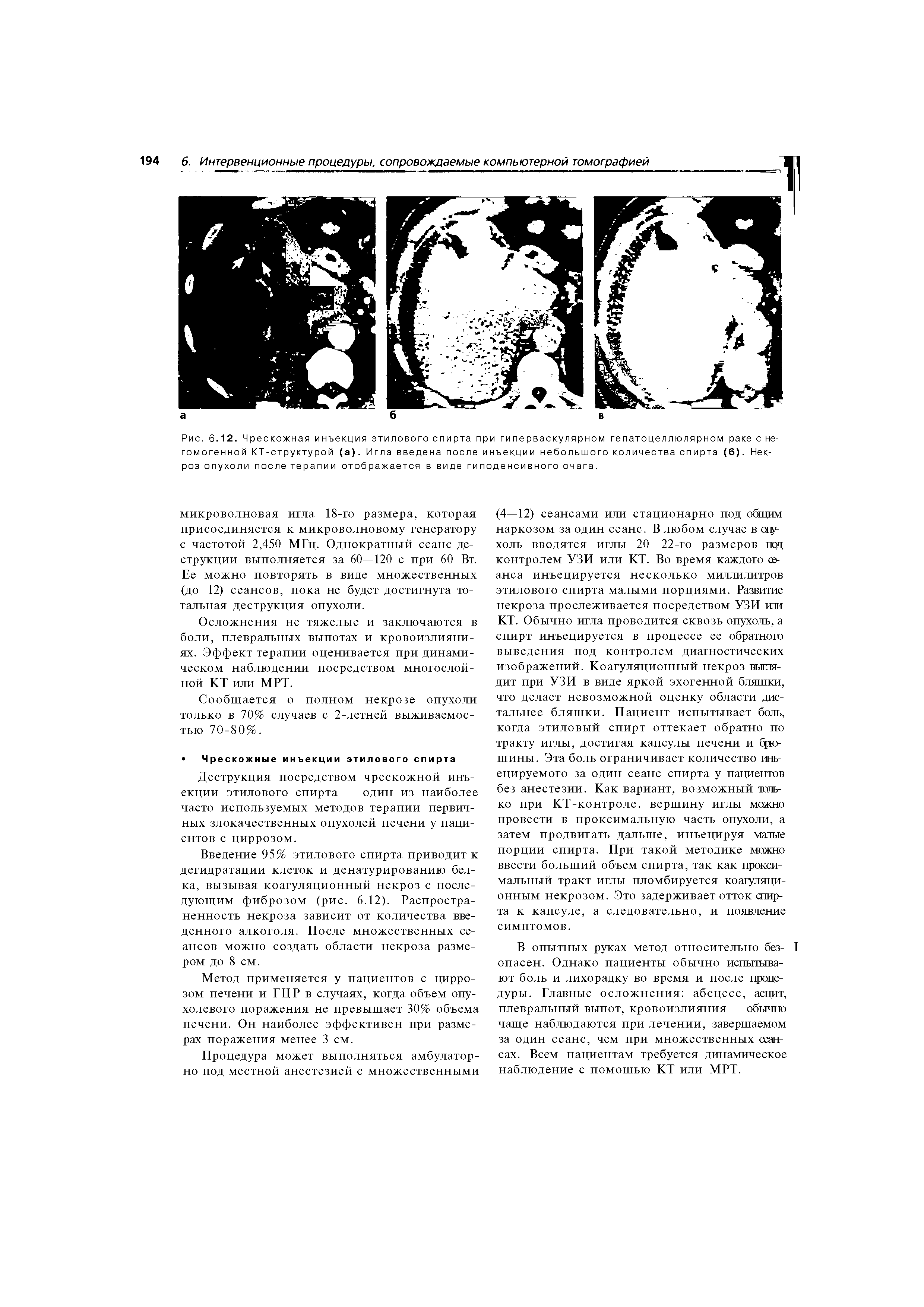 Рис. 6.12. Чрескожная инъекция этилового спирта при гиперваскулярном гепатоцеллюлярном раке с негомогенной КТ-структурой (а). Игла введена после инъекции небольшого количества спирта (6). Некроз опухоли после терапии отображается в виде гиподенсивного очага.