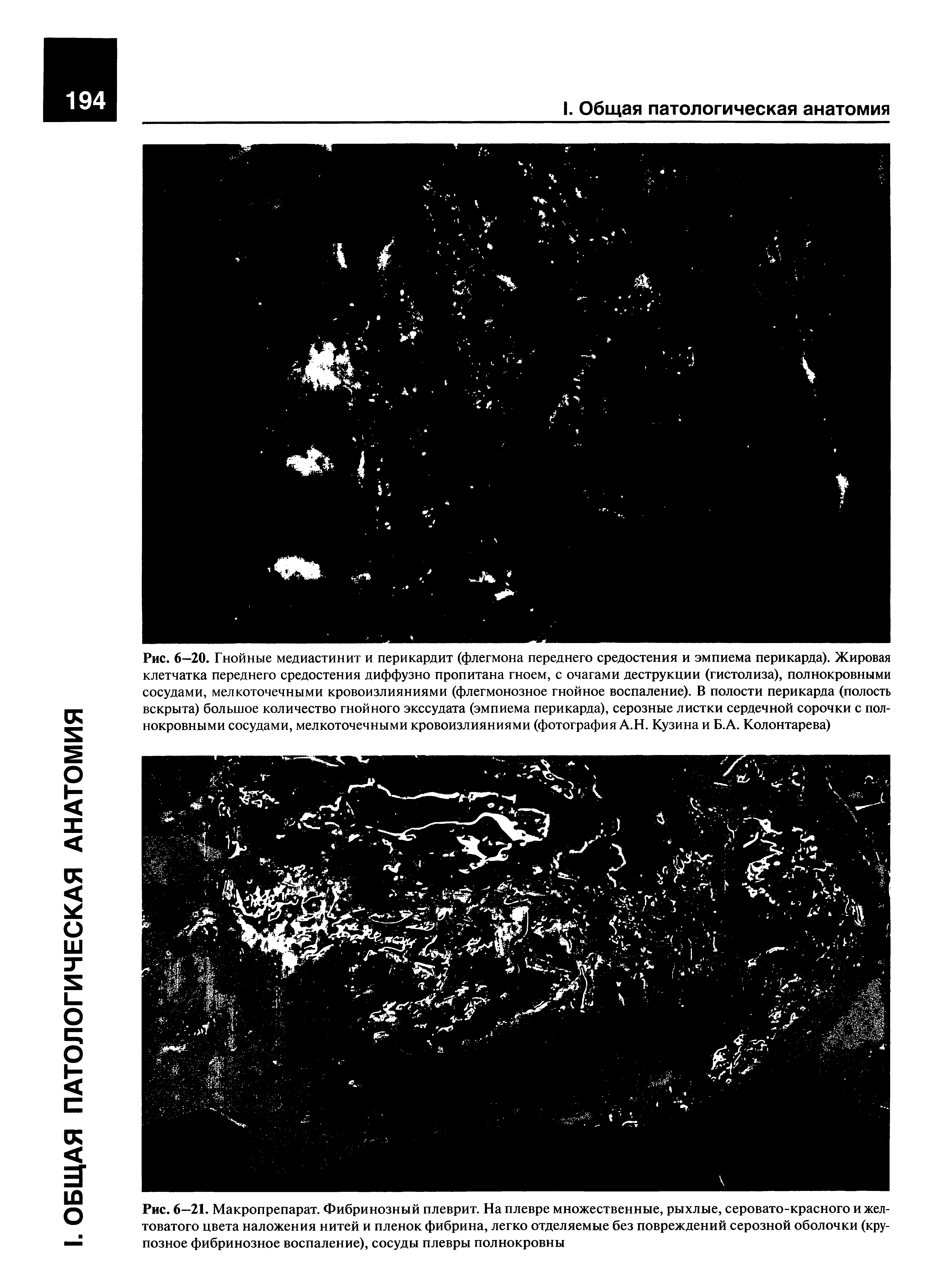 Рис. 6—21. Макропрепарат. Фибринозный плеврит. На плевре множественные, рыхлые, серовато-красного и желтоватого цвета наложения нитей и пленок фибрина, легко отделяемые без повреждений серозной оболочки (крупозное фибринозное воспаление), сосуды плевры полнокровны...