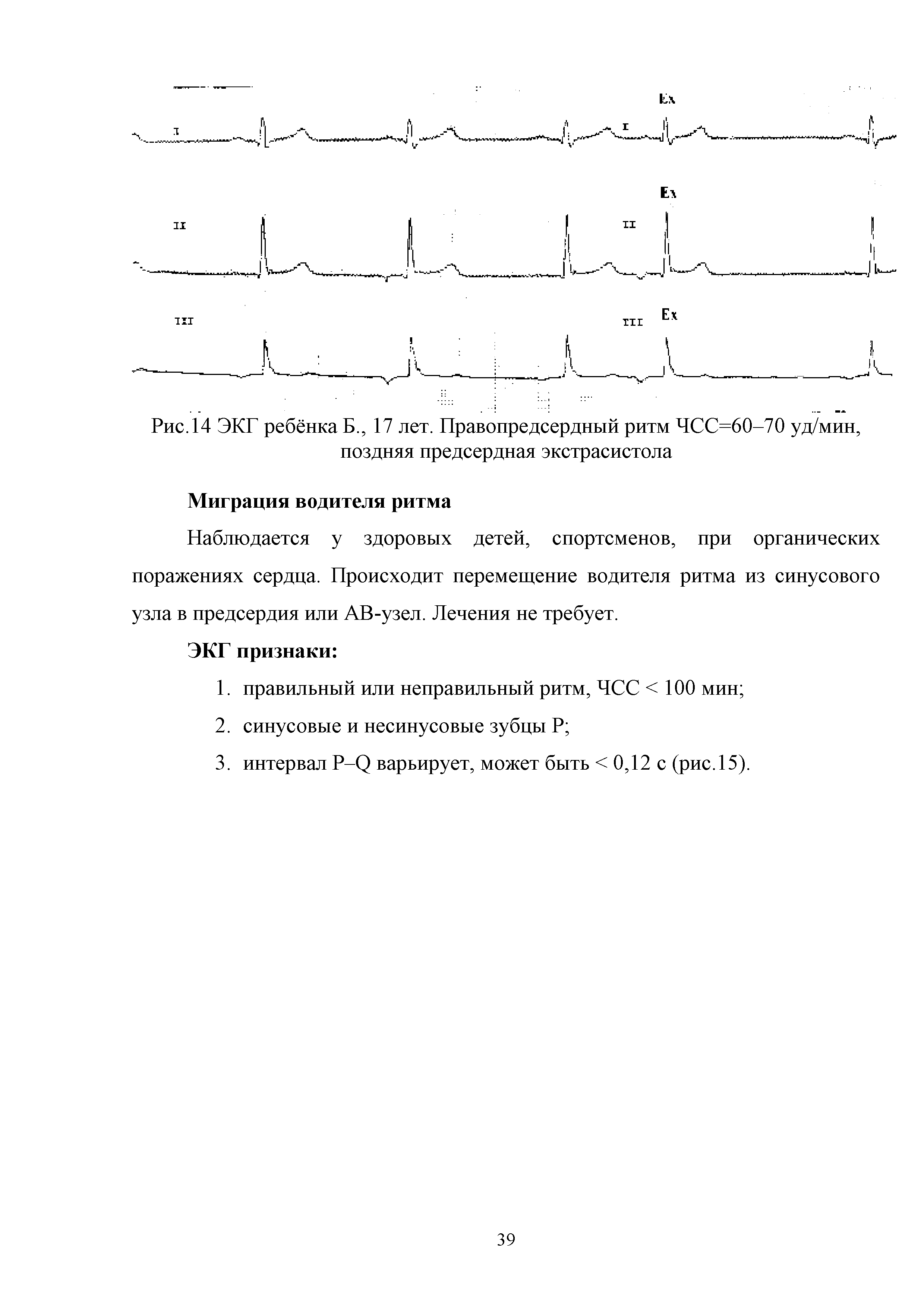 Рис. 14 ЭКГ ребёнка Б., 17 лет. Правопредсердный ритм ЧСС=60-70 уд/мин, поздняя предсердная экстрасистола...