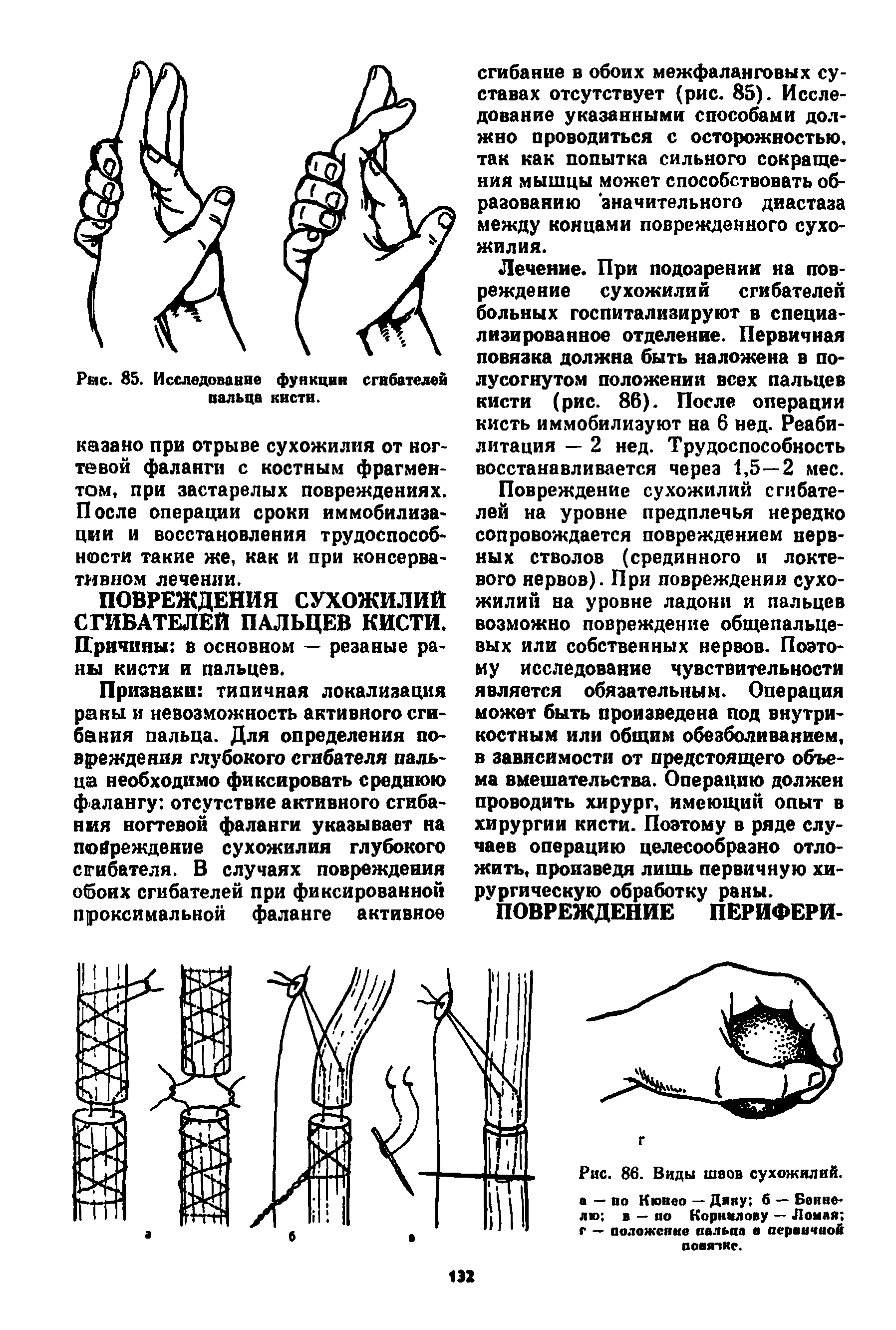 Рис. 86. Виды швов сухожилий, а — во Кювео — Дику б — Бонне-лю в — по Корнилову — Ломав г — положение пальца а первичной OOBB IK .