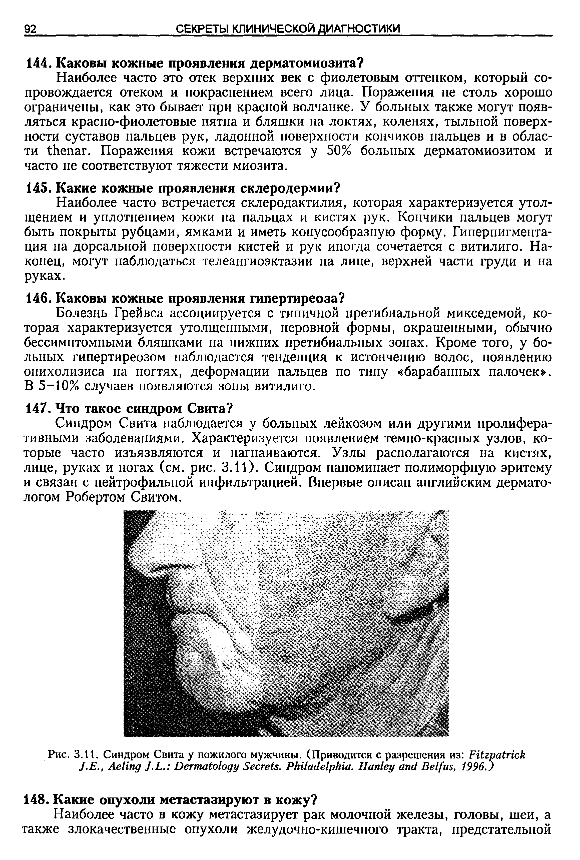 Рис. 3.11. Синдром Свита у пожилого мужчины. (Приводится с разрешения из F J.E., A J.L. D S . P . H B , 1996.)...