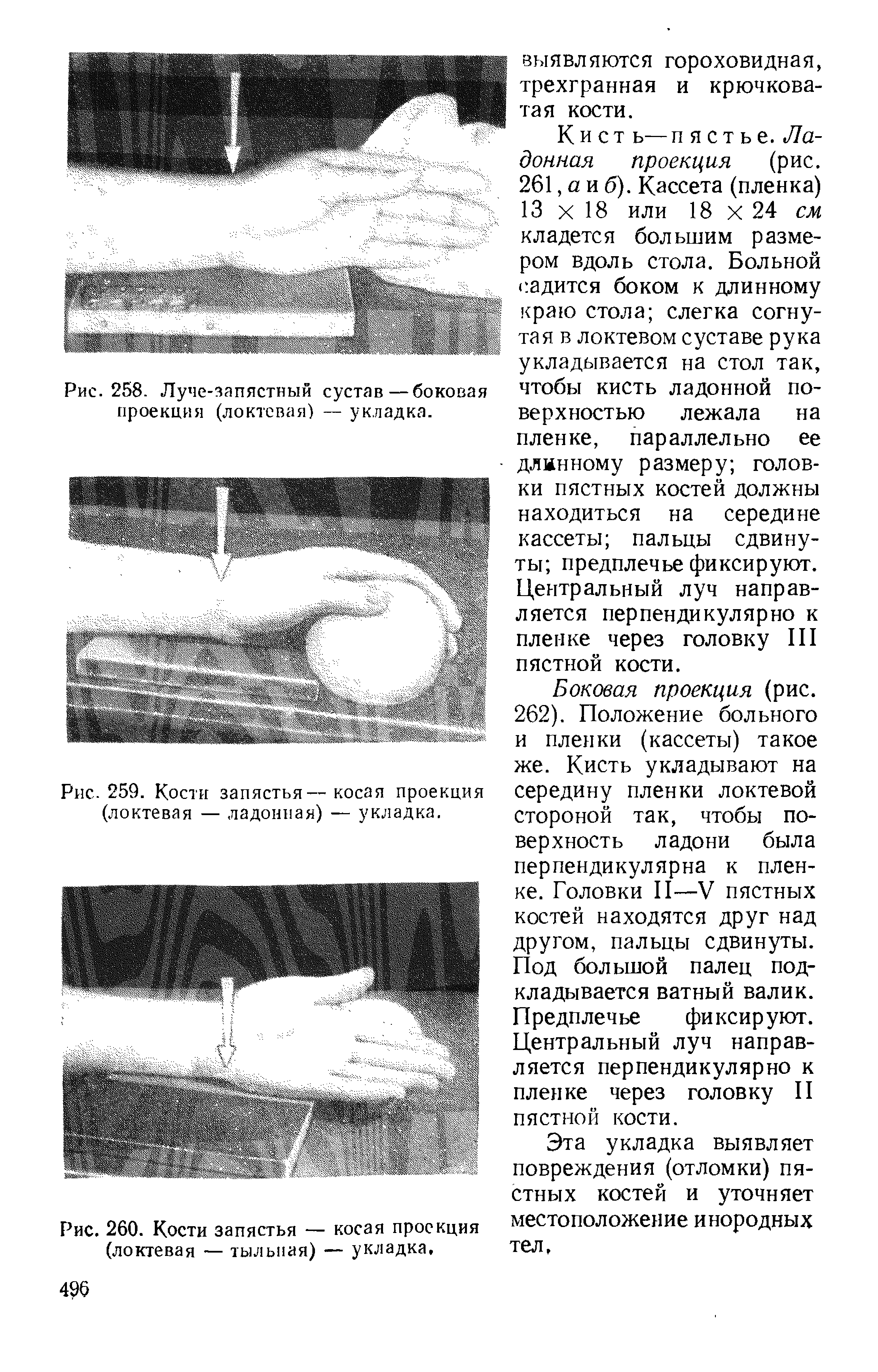 Рис. 259. Кости запястья— косая проекция (локтевая — ладонная) — укладка.