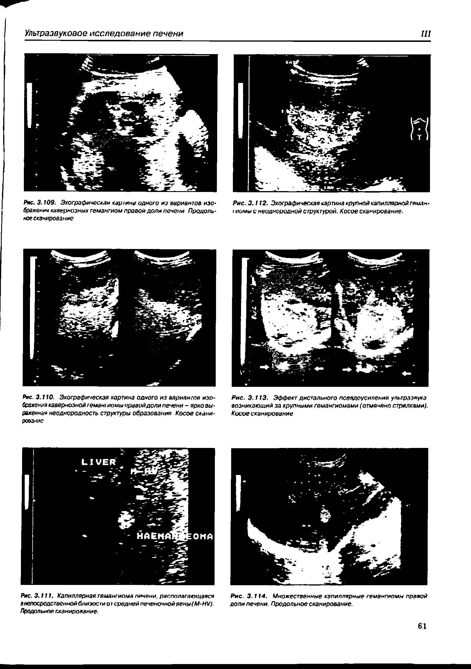 Рис. 3.113. Эффект дистального псеядоусиления ультразвука возникающий за крупными гемангиомами (отмечено стрелками) Косое сканирование...
