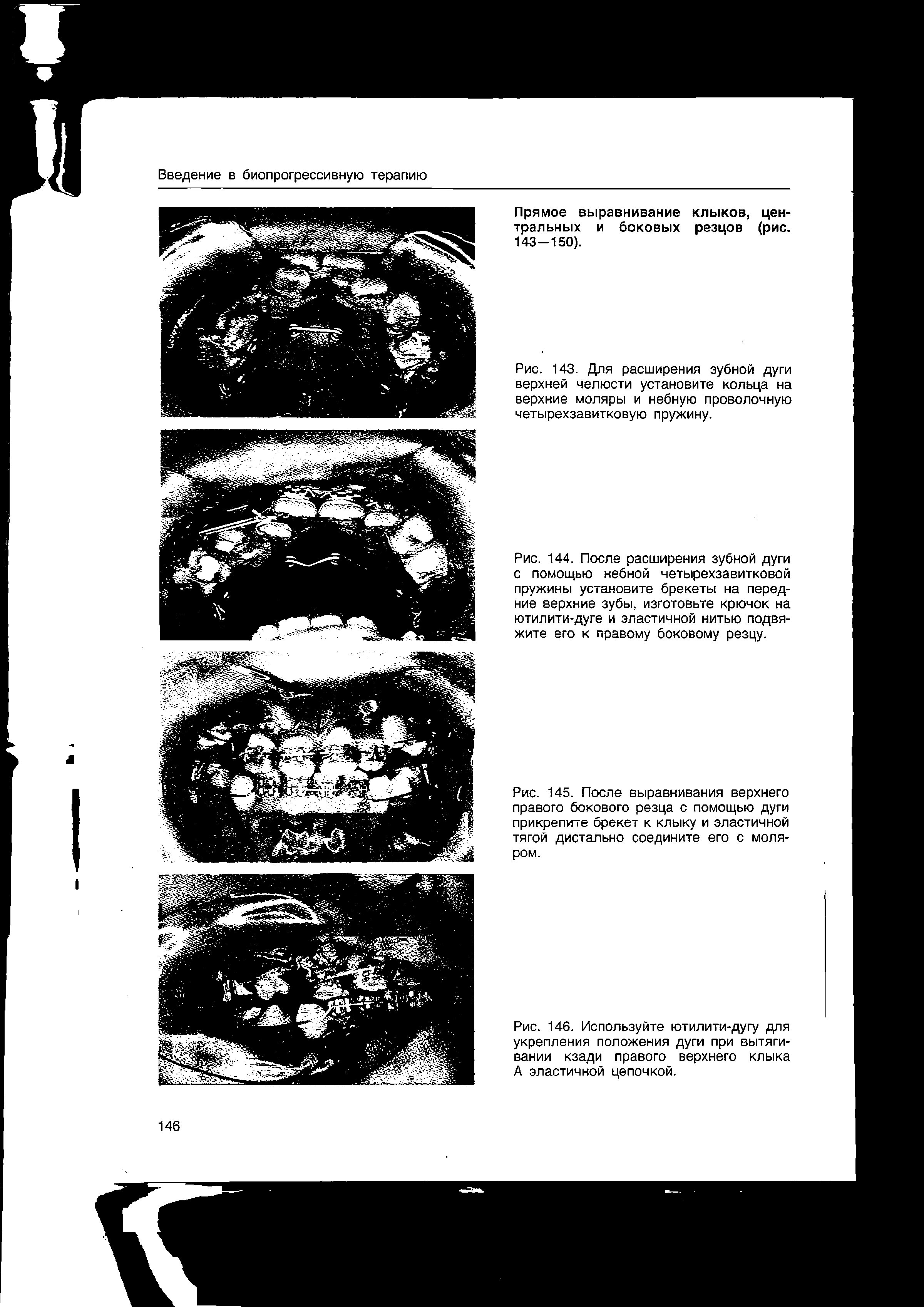 Рис. 145. После выравнивания верхнего правого бокового резца с помощью дуги прикрепите брекет к клыку и эластичной тягой дистально соедините его с моляром.
