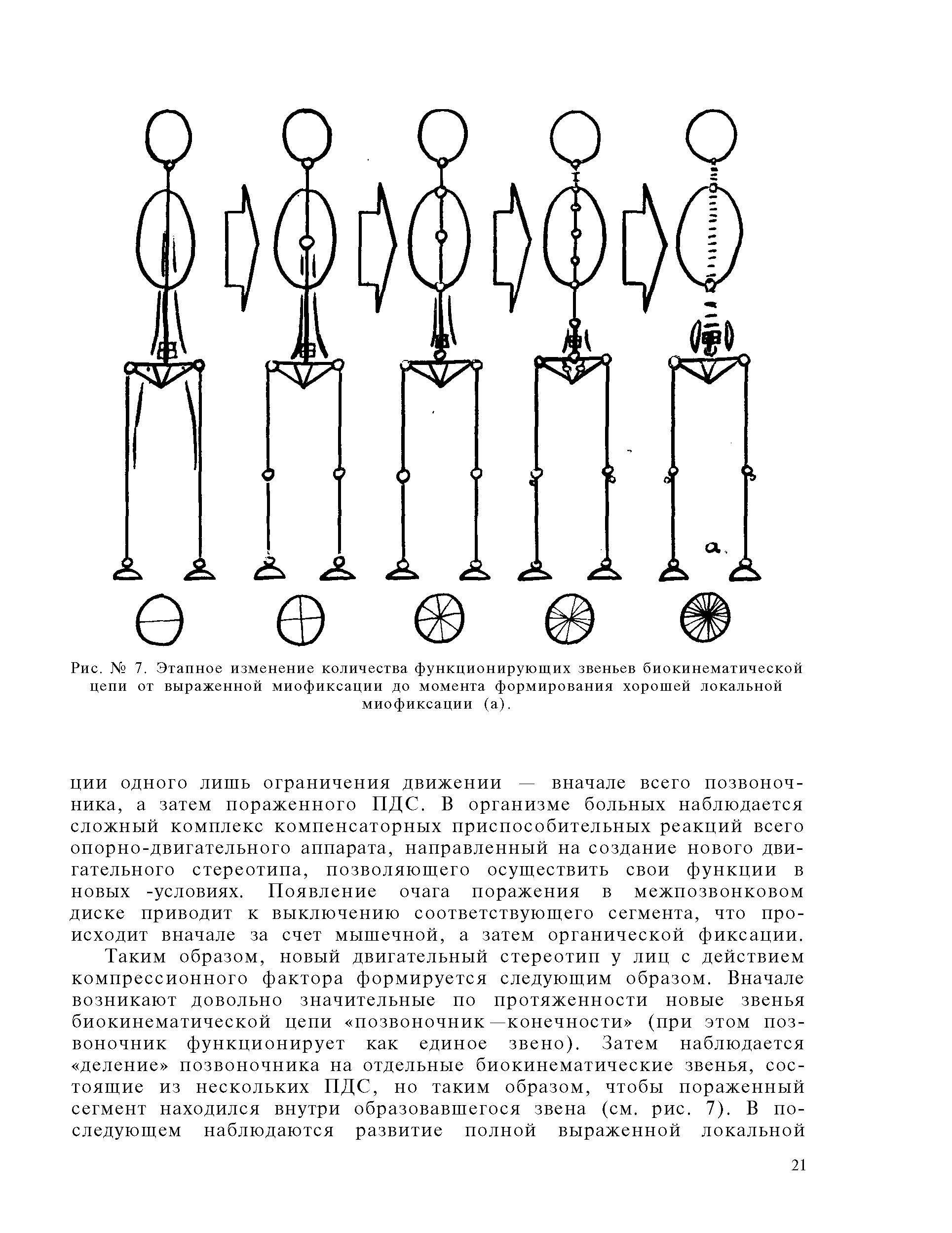 Рис. № 7. Этапное изменение количества функционирующих звеньев биокинематической цепи от выраженной миофиксации до момента формирования хорошей локальной миофиксации (а).