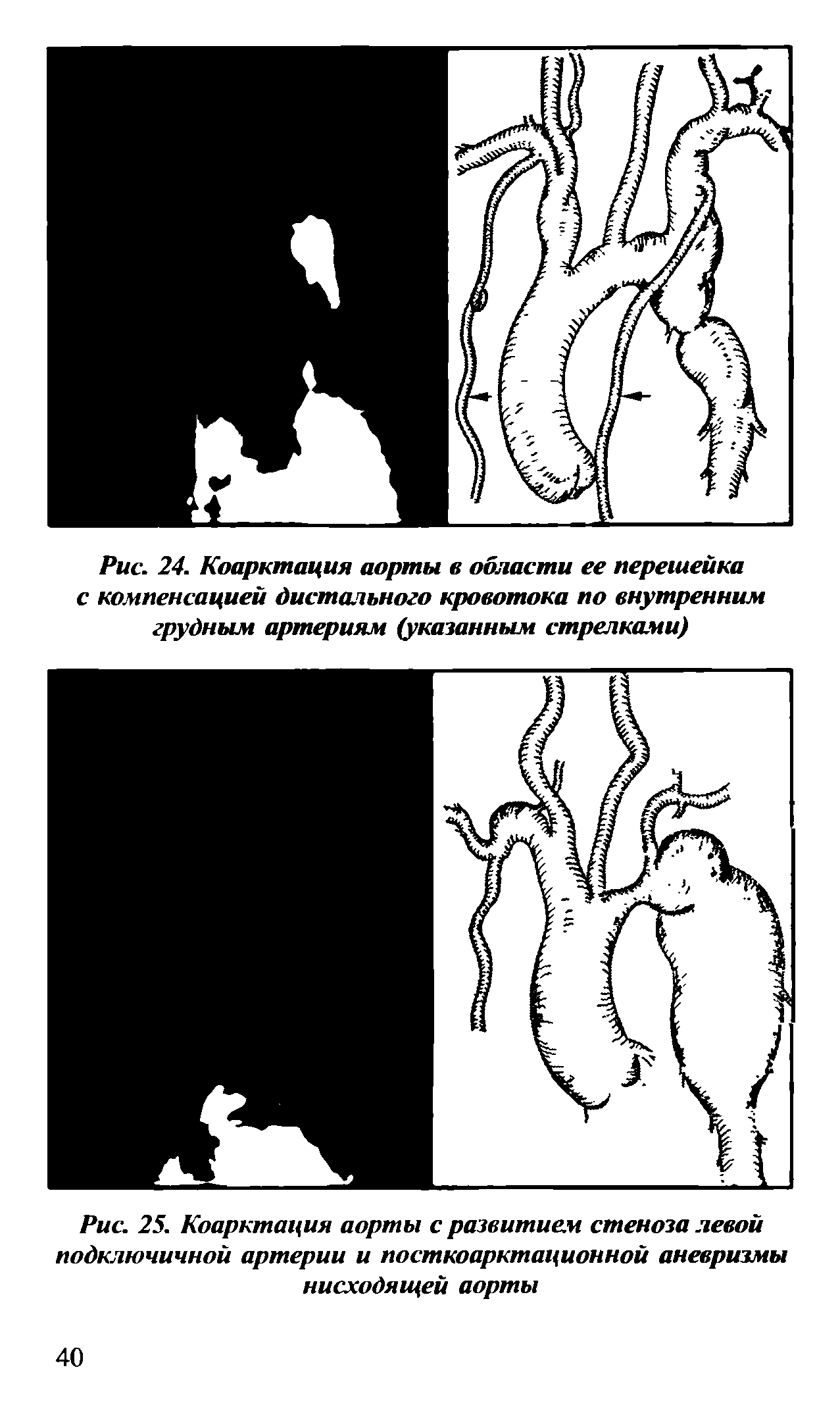 Рис. 25. Коарктация аорты с развитием стеноза левой подключичной артерии и посткоарктационной аневризмы нисходящей аорты...