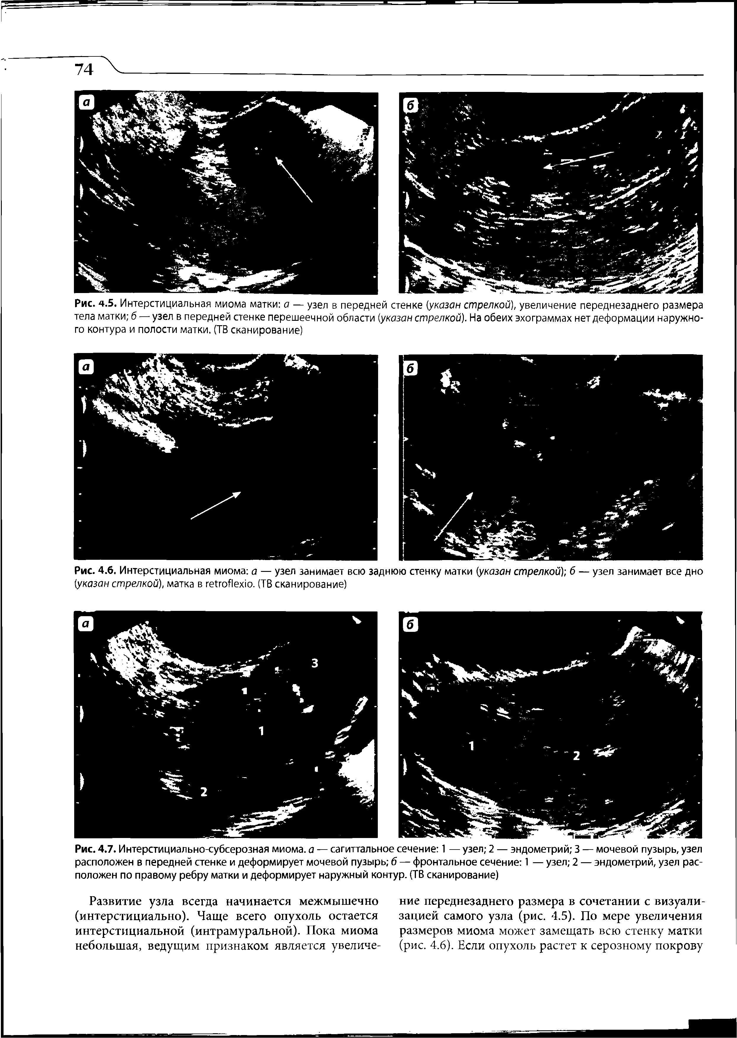 Рис. 4.6. Интерстициальная миома а — узел занимает всю заднюю стенку матки (указан стрелкой) б — узел занимает все дно (указан стрелкой), матка в геПоАехю. (ТВ сканирование)...