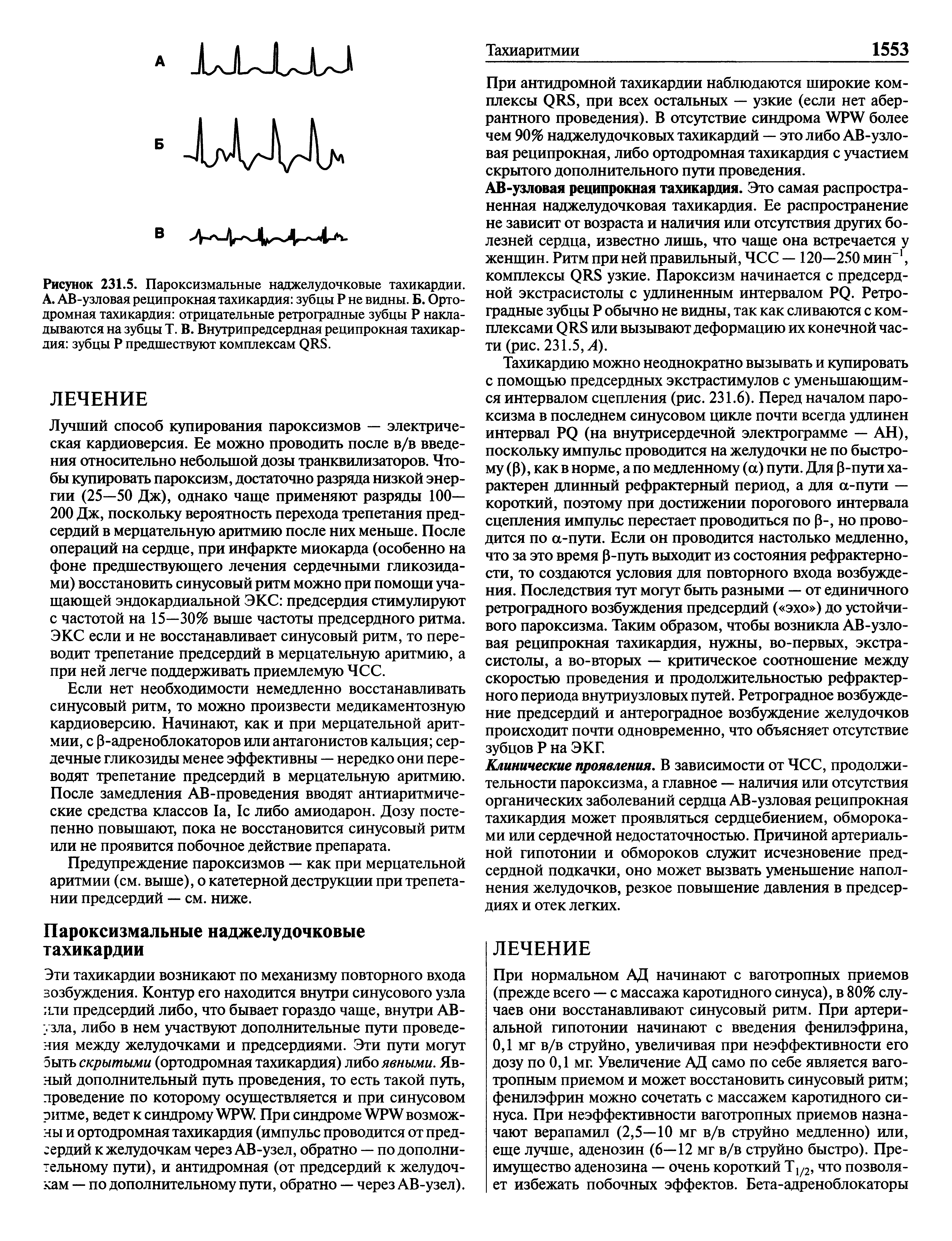 Рисунок 231.5. Пароксизмальные наджелудочковые тахикардии. А. АВ-узловая реципрокная тахикардия зубцы Р не видны. Б. Орто-дромная тахикардия отрицательные ретроградные зубцы Р накладываются на зубцы Т. В. Внутрипредсердная реципрокная тахикардия зубцы Р предшествуют комплексам рЯ8.