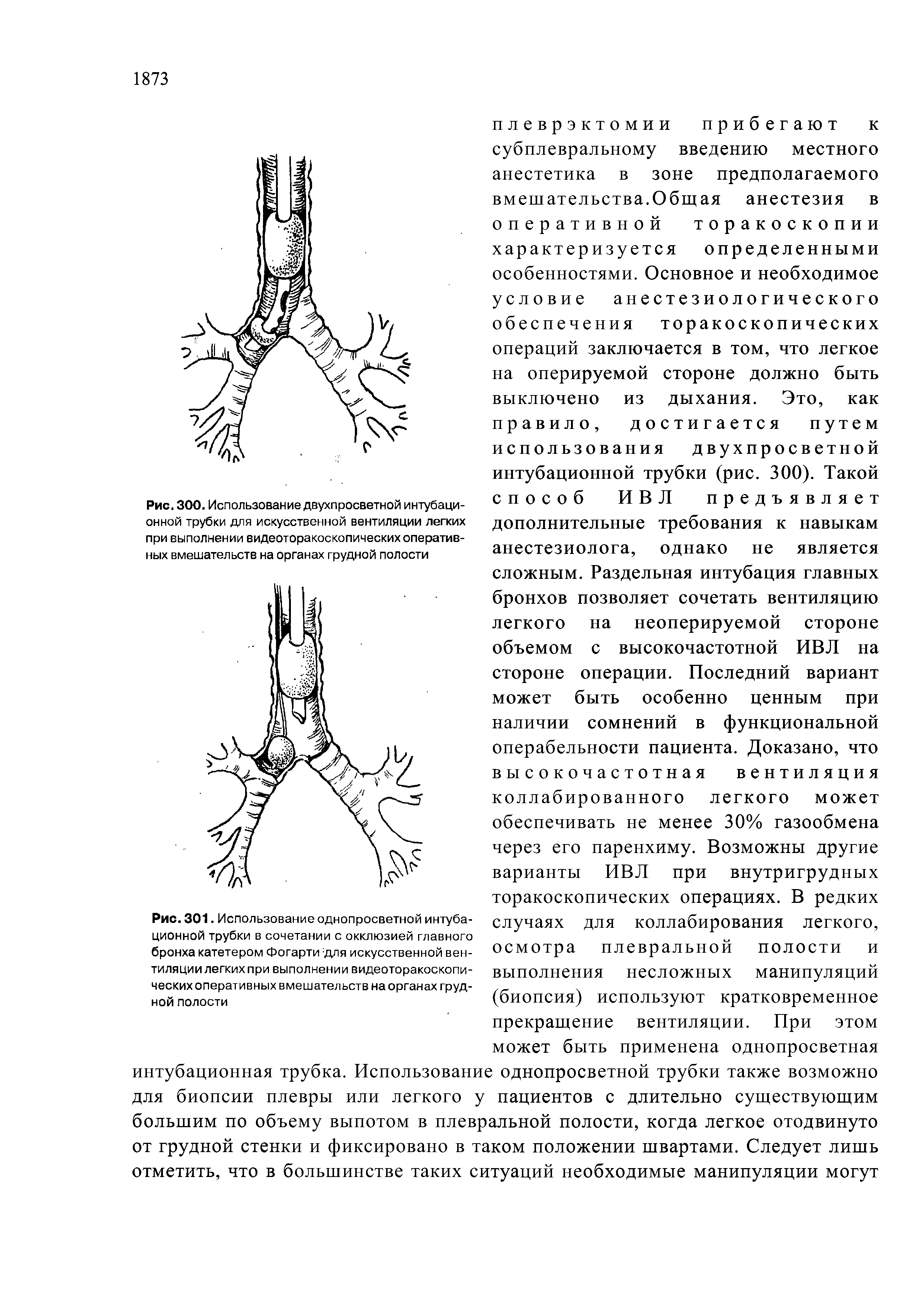 Рис. 300. Использование двухпросветной интубационной трубки для искусственной вентиляции легких при выполнении видеоторакоскопических оперативных вмешательств на органах грудной полости...