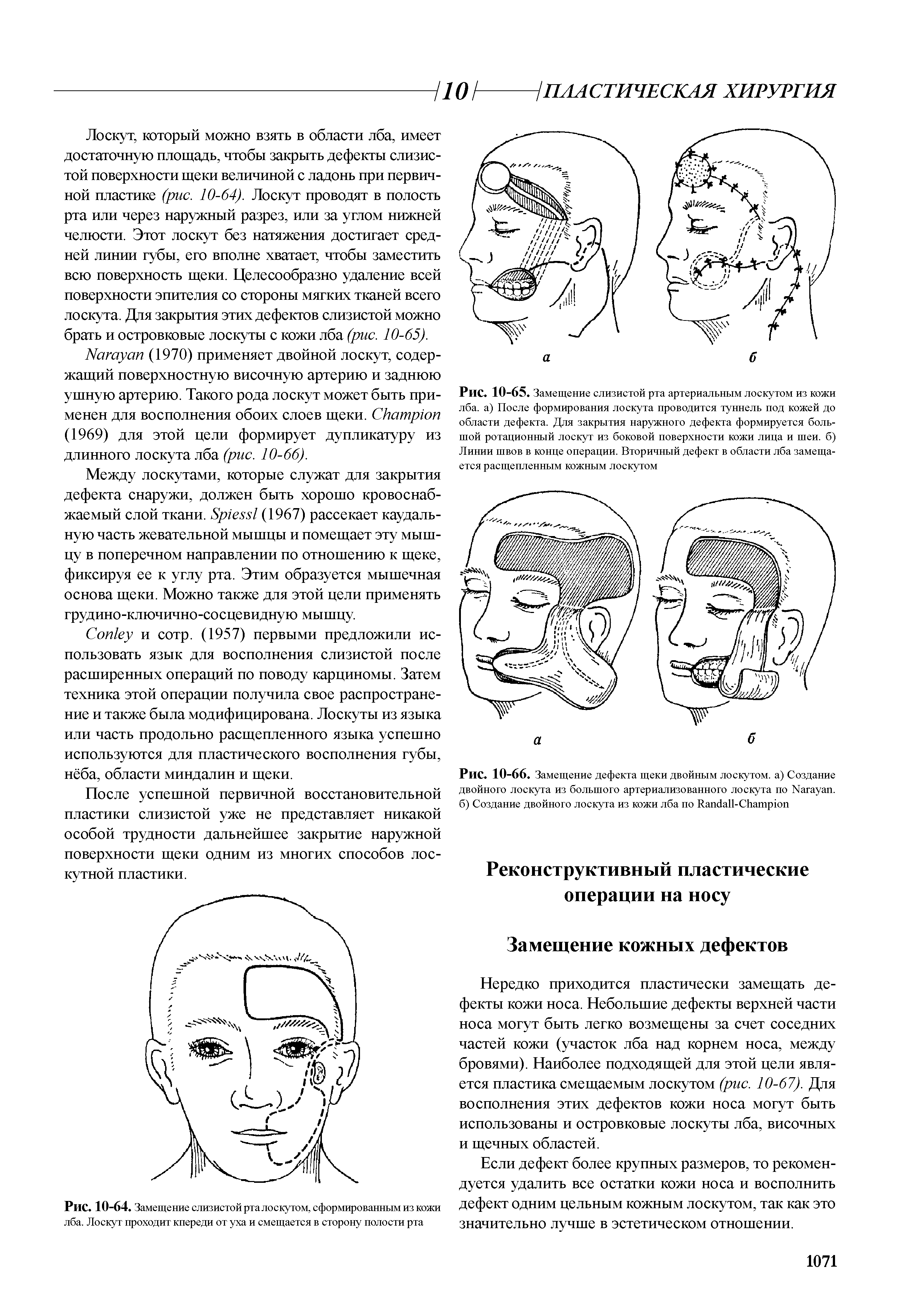 Рис. 10-66. Замещение дефекта щеки двойным лоскутом, а) Создание двойного лоскута из большого артериализованного лоскута по N , б) Создание двойного лоскута из кожи лба по R -C ...