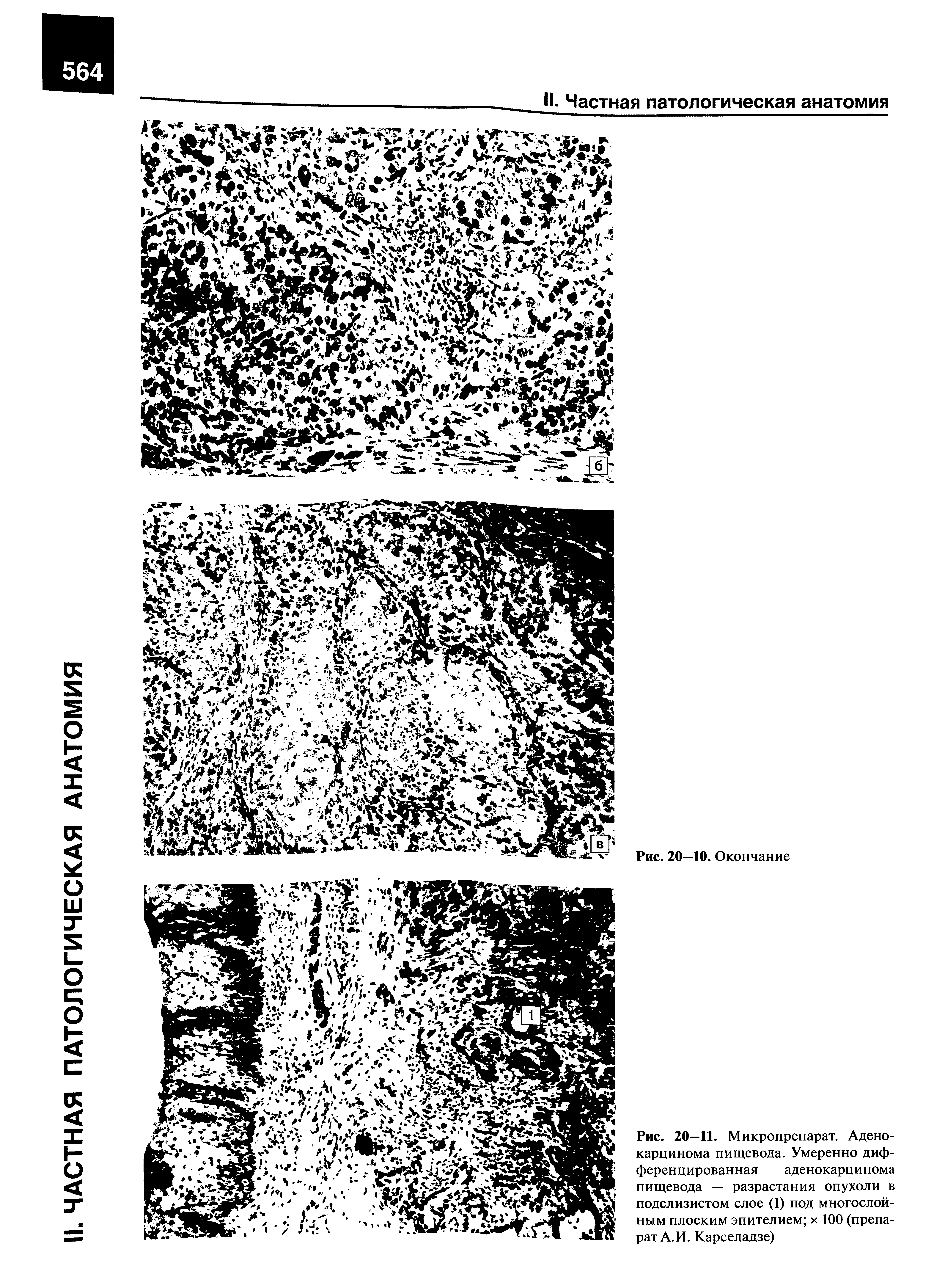 Рис. 20—11. Микропрепарат. Аденокарцинома пищевода. Умеренно дифференцированная аденокарцинома пищевода — разрастания опухоли в подслизистом слое (1) под многослойным плоским эпителием х 100 (препарат А. И. Карселадзе)...