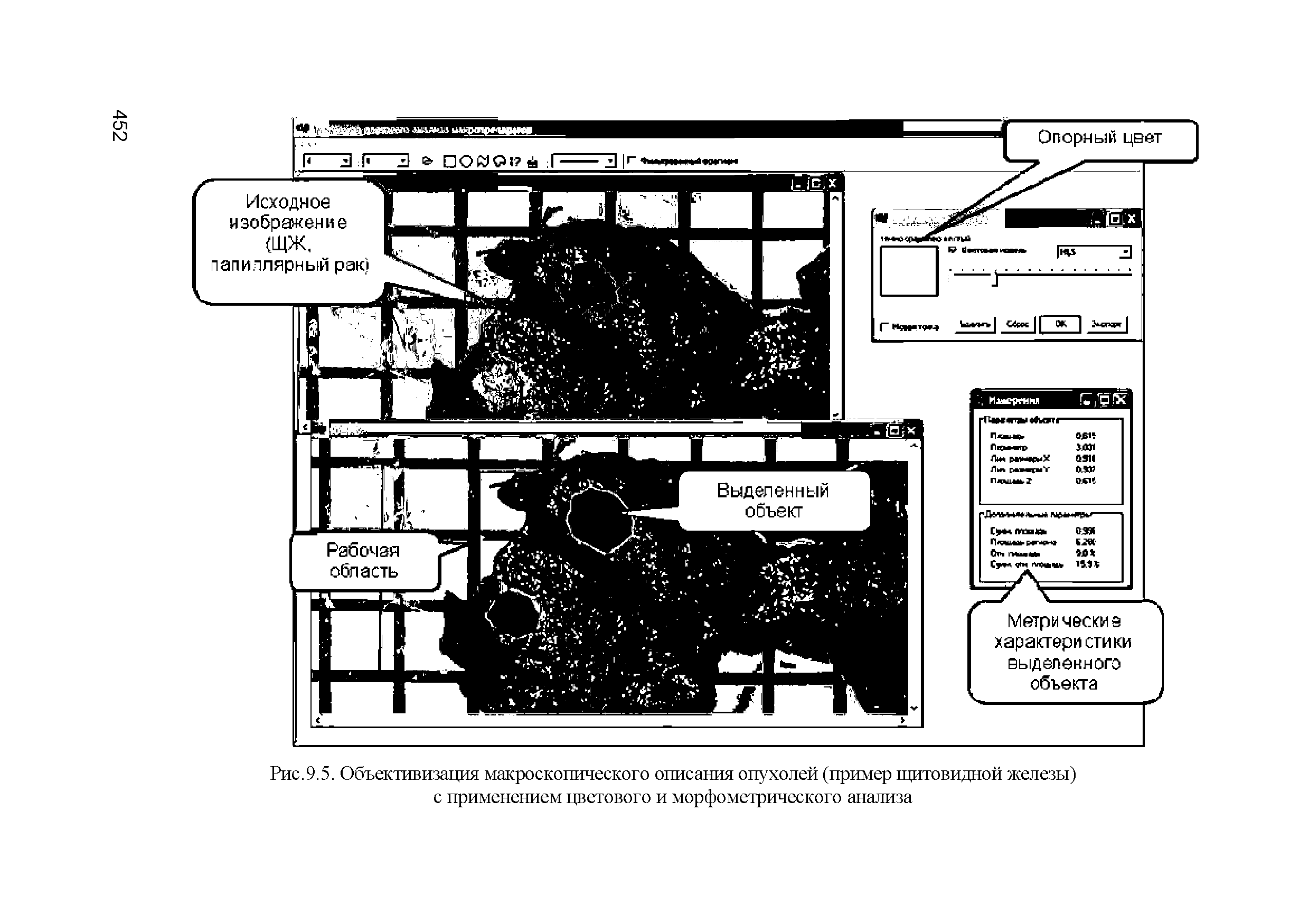 Рис.9.5. Объективизация макроскопического описания опухолей (пример щитовидной железы) с применением цветового и морфометрического анализа...