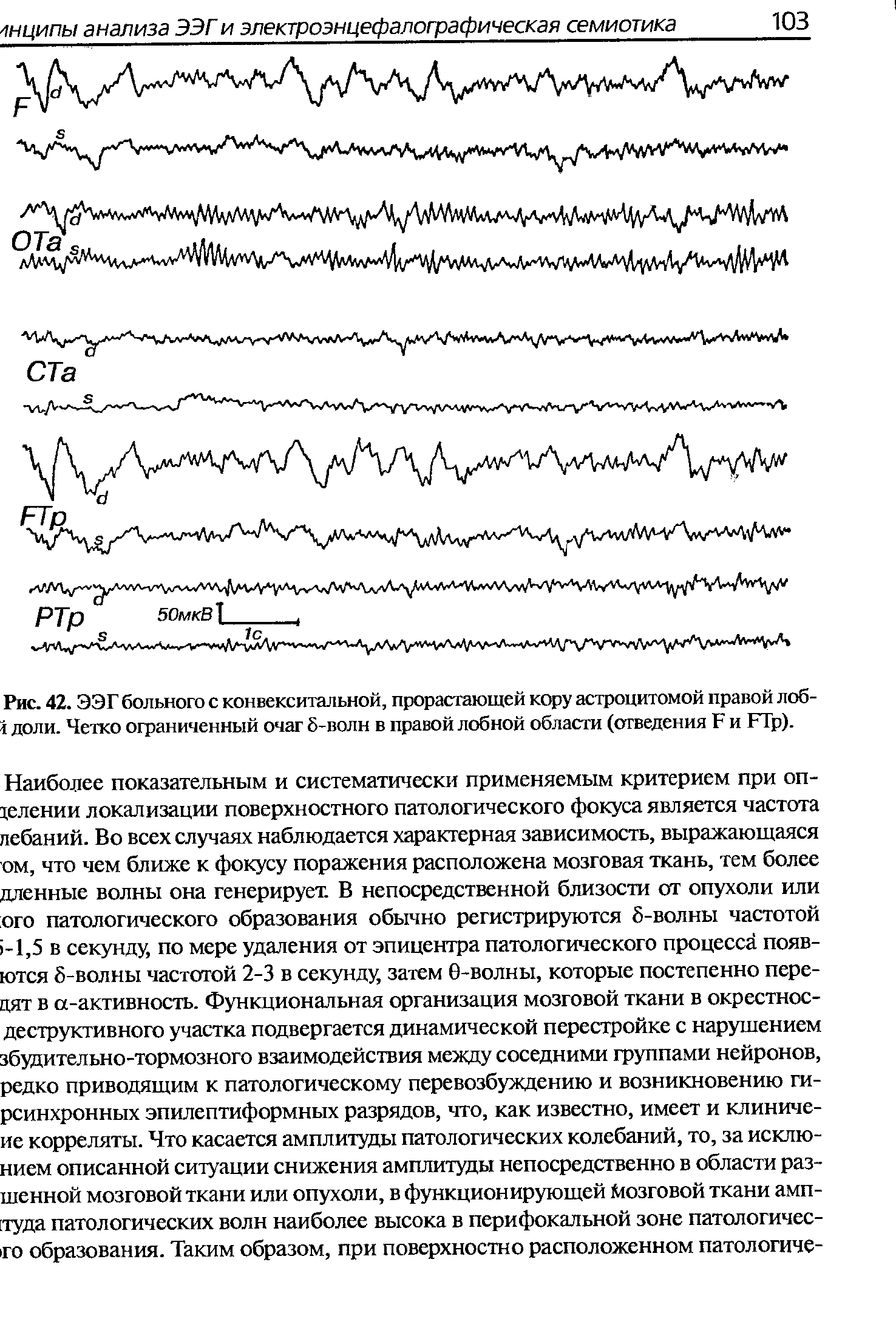 Рис. 42. ЭЭГ больного с конвекситальной, прорастающей кору астроцитомой правой лоб-...