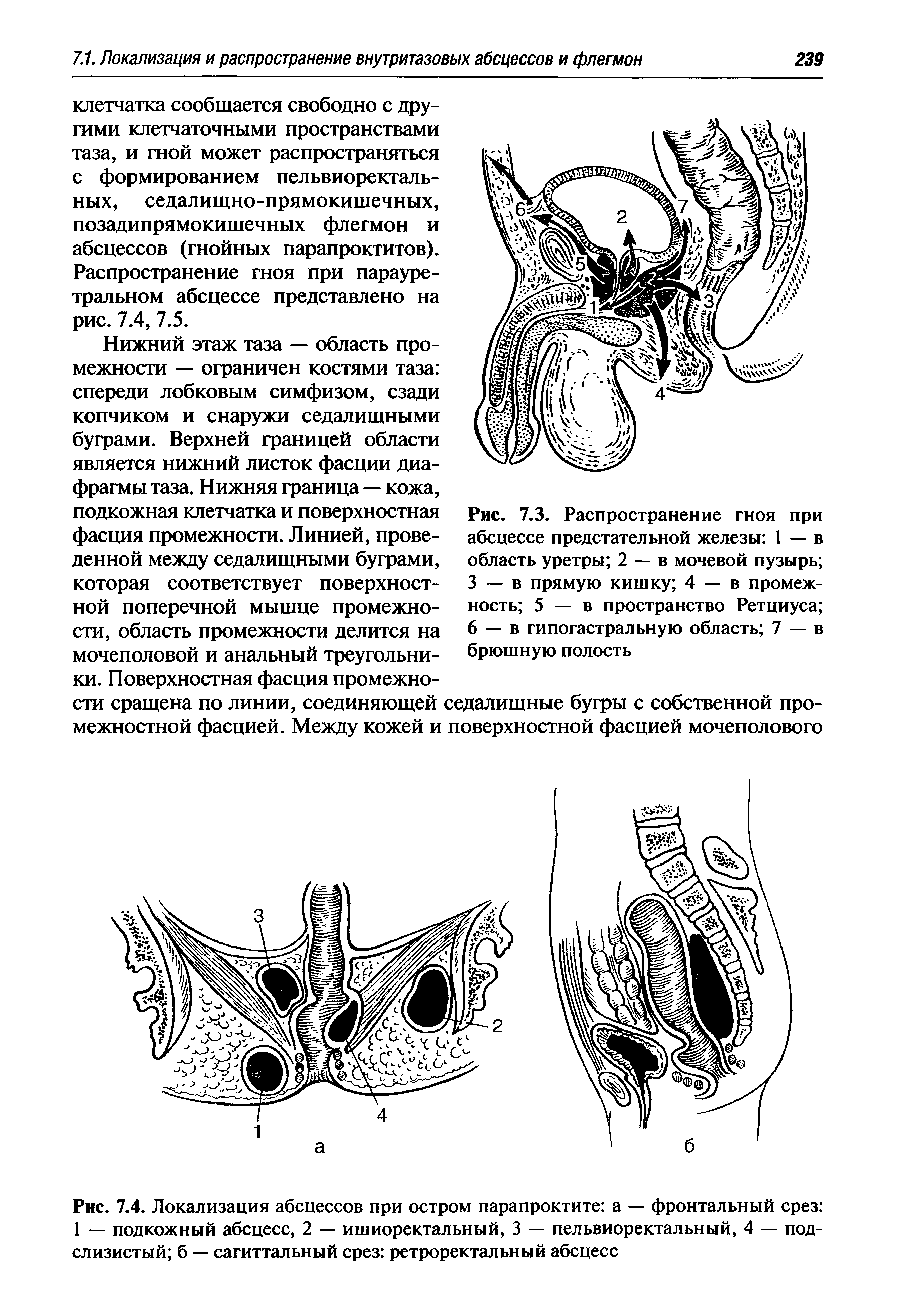 Парапроктит острый клиническая картина