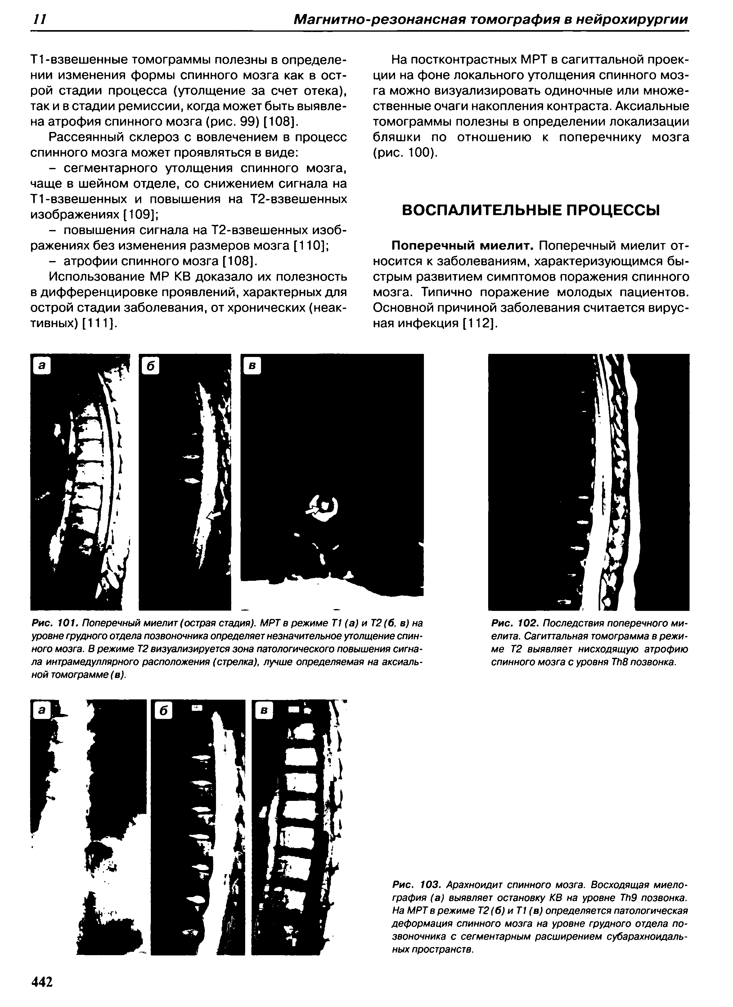 Рис. 101. Поперечный миелит (острая стадия). МРТ в режиме Т1 (а) и Т2(6, в) на уровне грудного отдела позвоночника определяет незначительное утолщение спинного мозга. В режиме Т2 визуализируется зона патологического повышения сигнала интрамедуллярного расположения (стрелка), лучше определяемая на аксиальной томограмме (в).