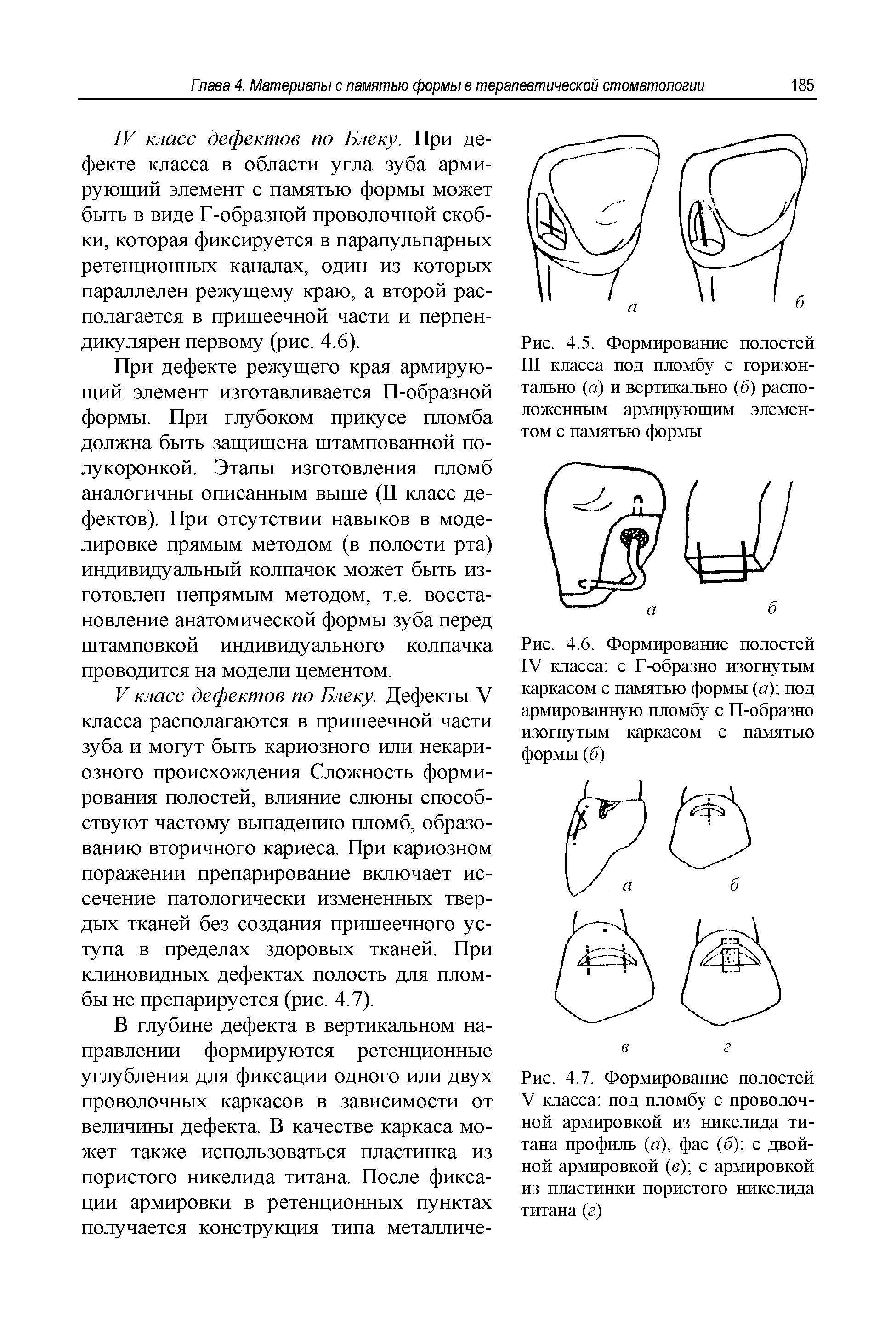 Рис. 4.6. Формирование полостей IV класса с Г-образно изогнутым каркасом с памятью формы (а) под армированную пломбу с П-образно изогнутым каркасом с памятью формы (б)...