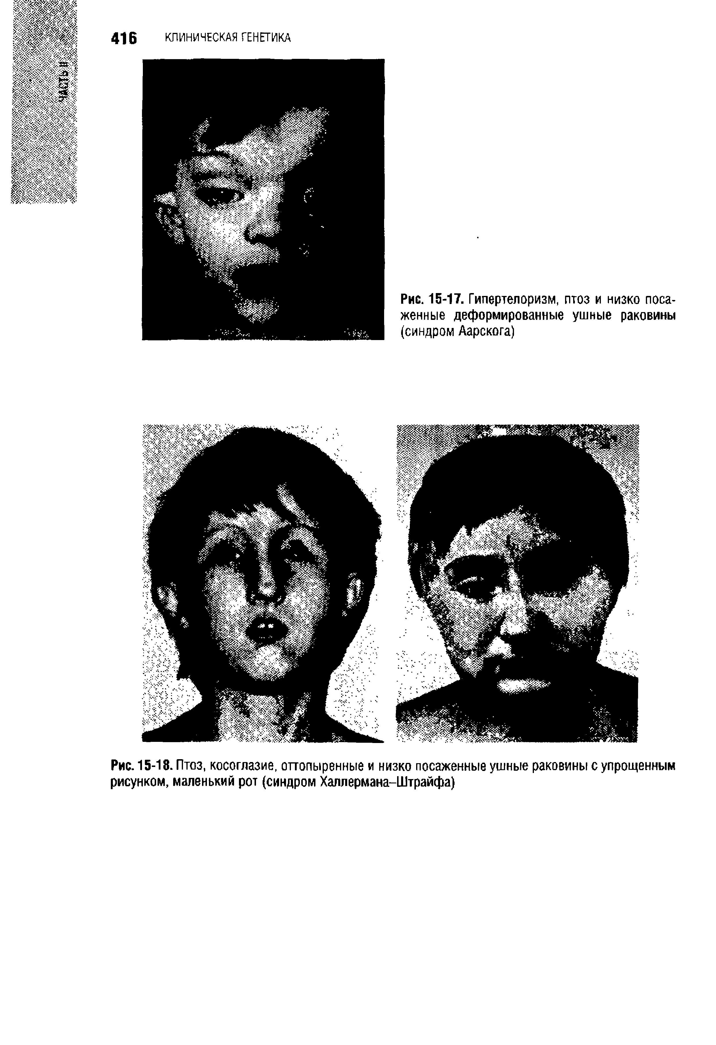 Рис. 15-18. Птоз, косоглазие, оттопыренные и низко посаженные ушные раковины с упрощенным рисунком, маленький рот (синдром Халлермана-Штрайфа)...