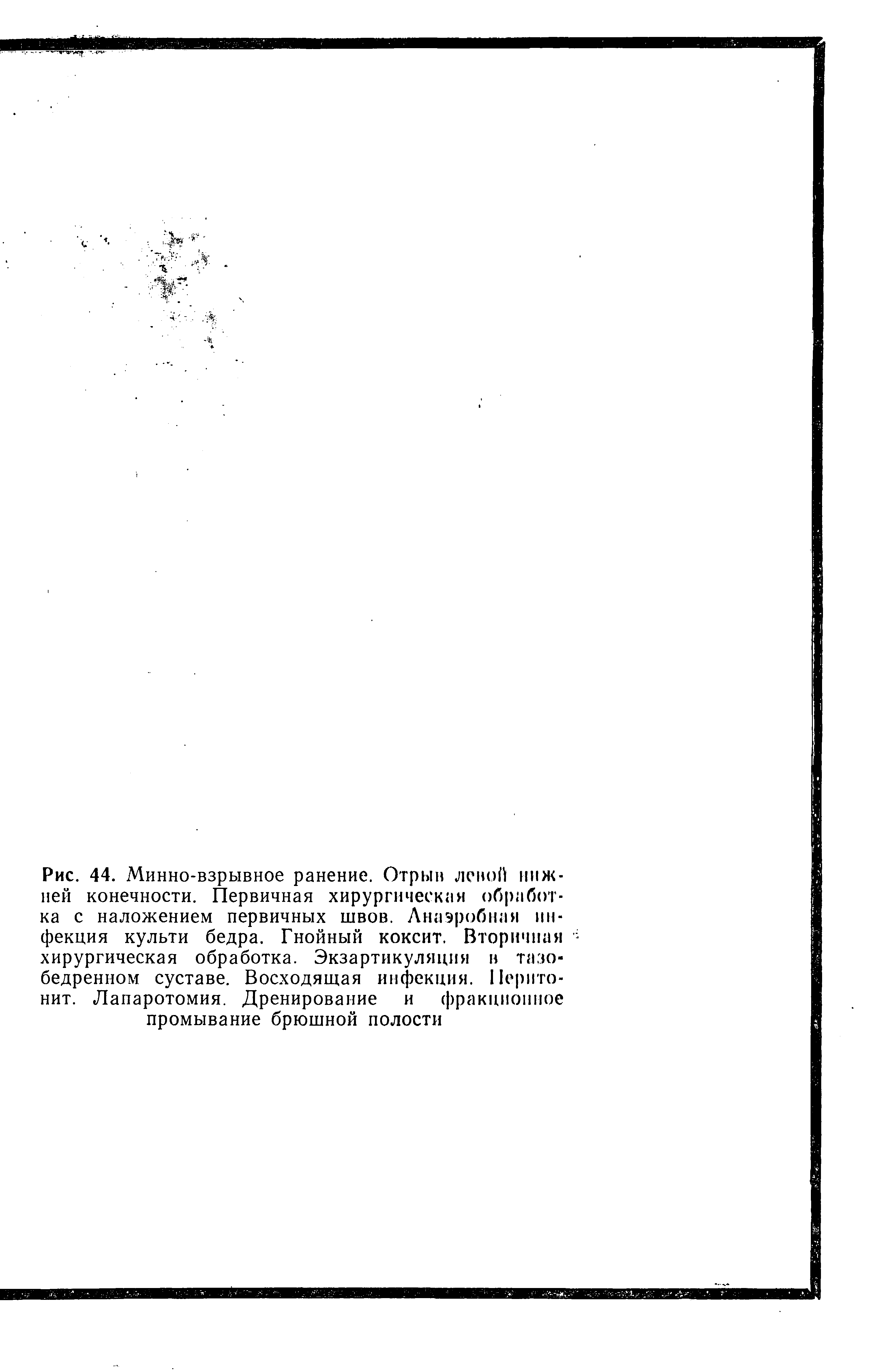 Рис. 44. Минно-взрывное ранение. Отрыв левой нижней конечности. Первичная хирургическая обработка с наложением первичных швов. Анаэробная инфекция культи бедра. Гнойный коксит. Вторичная хирургическая обработка. Экзартикуляция в тазобедренном суставе. Восходящая инфекция. Перитонит. Лапаротомия. Дренирование и фракционное промывание брюшной полости...