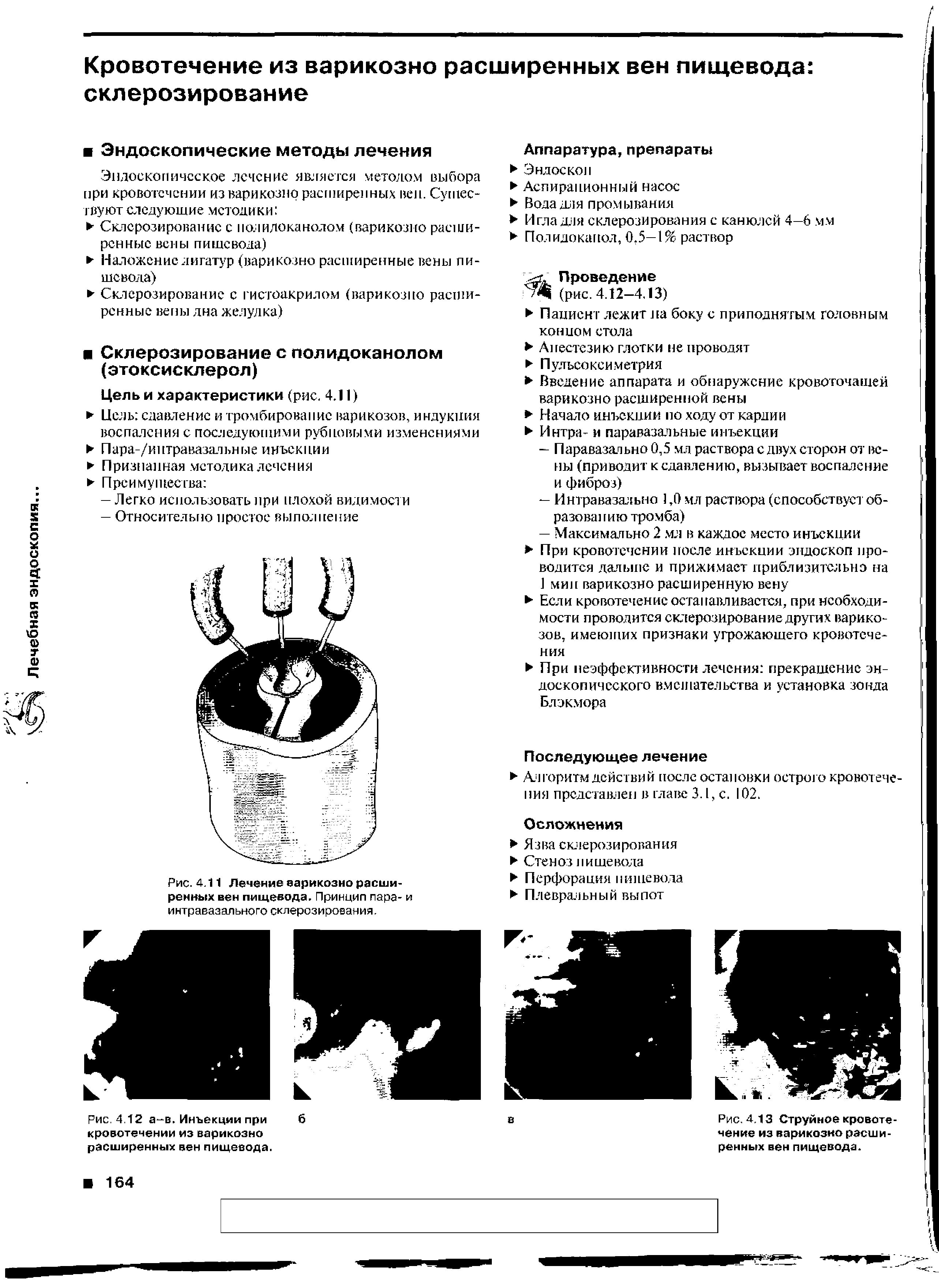 Рис. 4.11 Лечение варикозно расширенных вен пищевода. Принцип пара- и и нтр аваз ал ьно го склере з и рое ан и я.