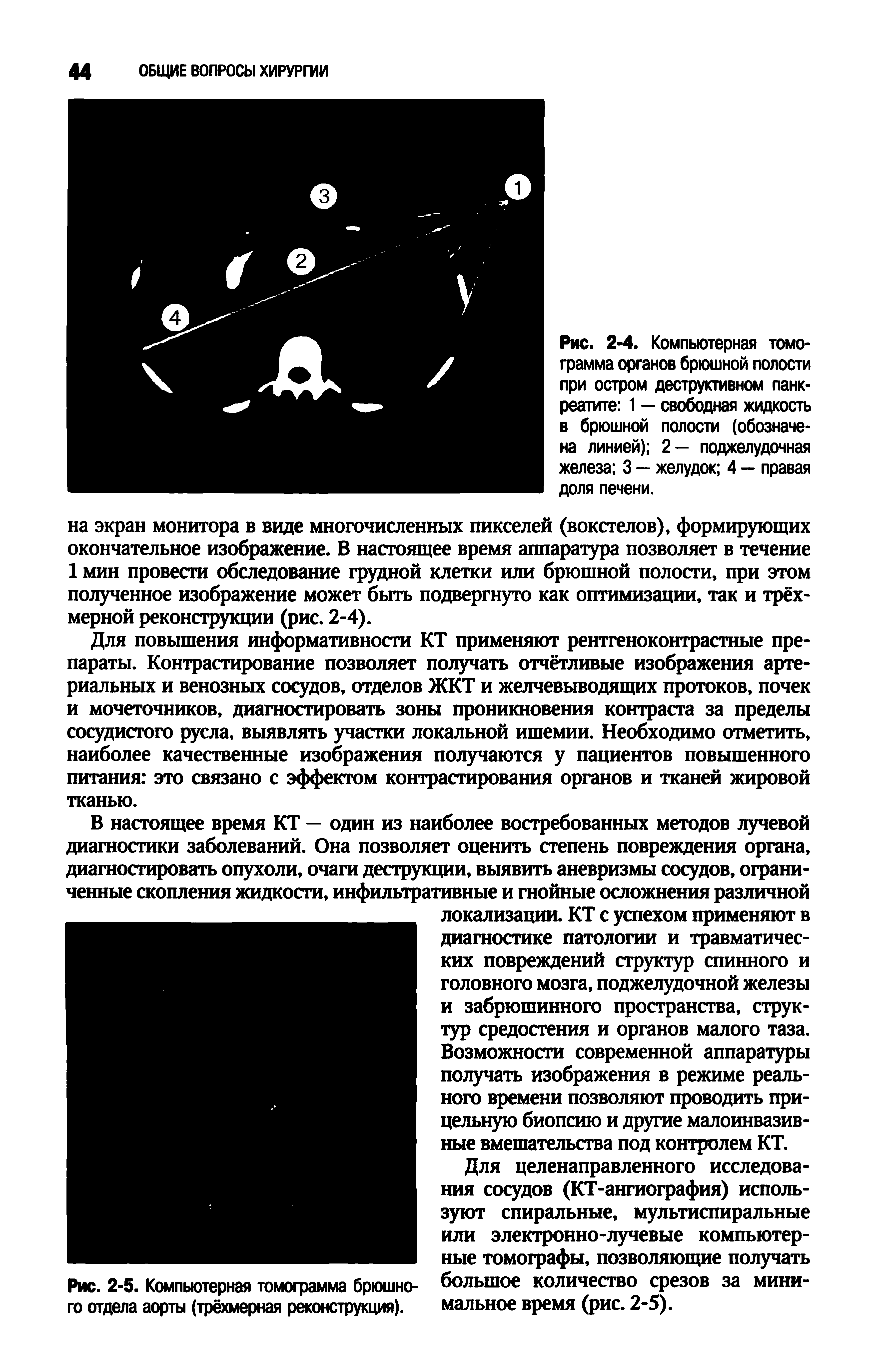 Рис. 2-5. Компьютерная томограмма брюшного отдела аорты (трёхмерная реконструкция).