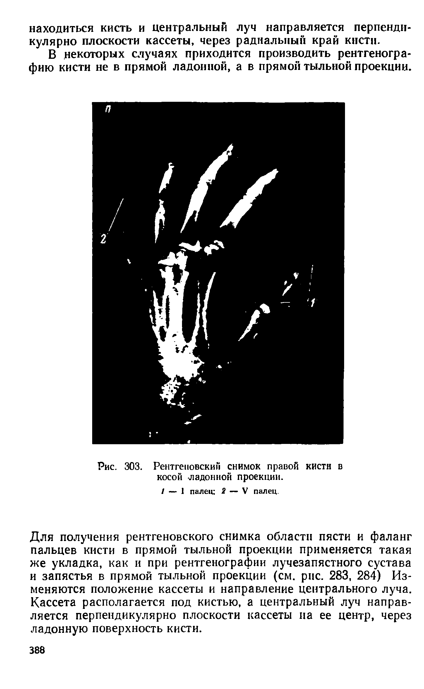 Рис. 303. Рентгеновским снимок правой кисти в косой ладонной проекции.