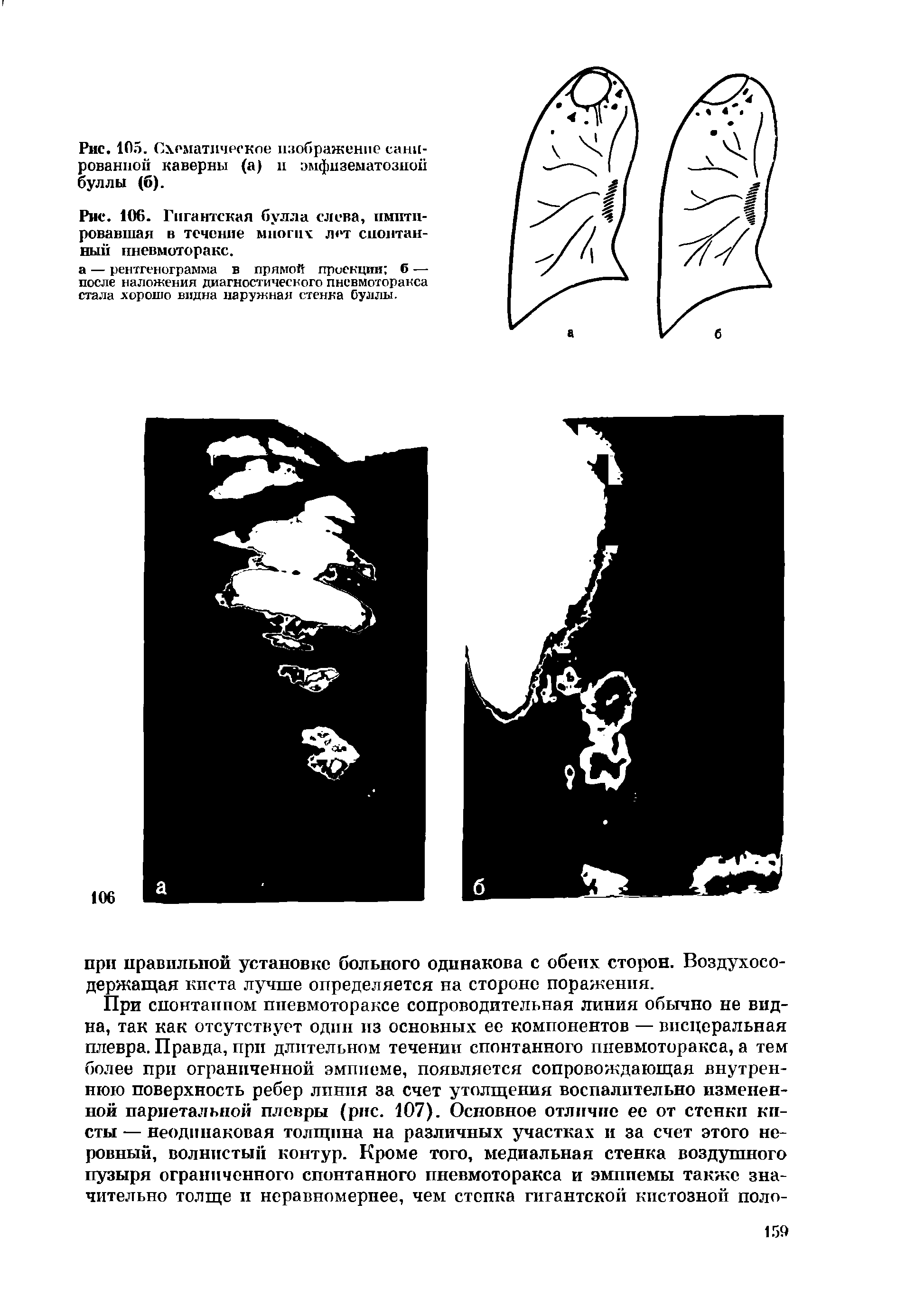 Рис. 106. Гигантская булла слева, имитировавшая в течение многих лет спонтанный пневмоторакс.