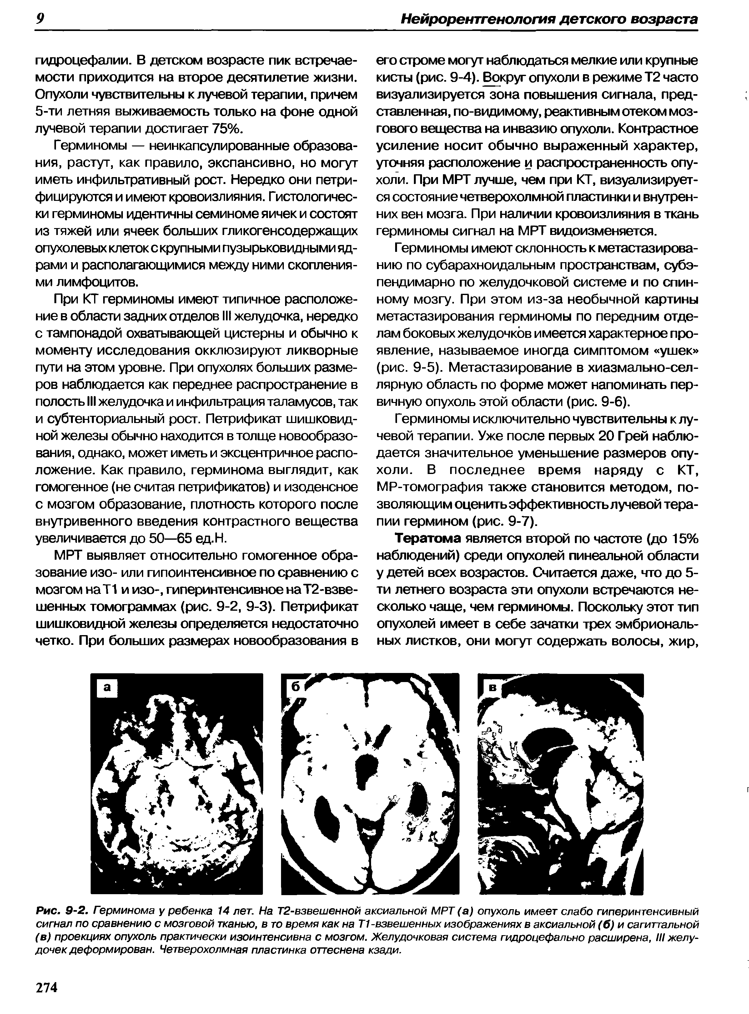 Рис. 9-2. Герминома у ребенка 14 лет. На Т2-взвешенной аксиальной МРТ (а) опухоль имеет слабо гиперинтенсивный сигнал по сравнению с мозговой тканью, в то время как на Т1-взвешенных изображениях в аксиальной (б) и сагиттальной (в) проекциях опухоль практически изоинтенсивна с мозгом. Желудочковая система гидроцефально расширена, III желудочек деформирован. Четверохолмная пластинка оттеснена кзади.