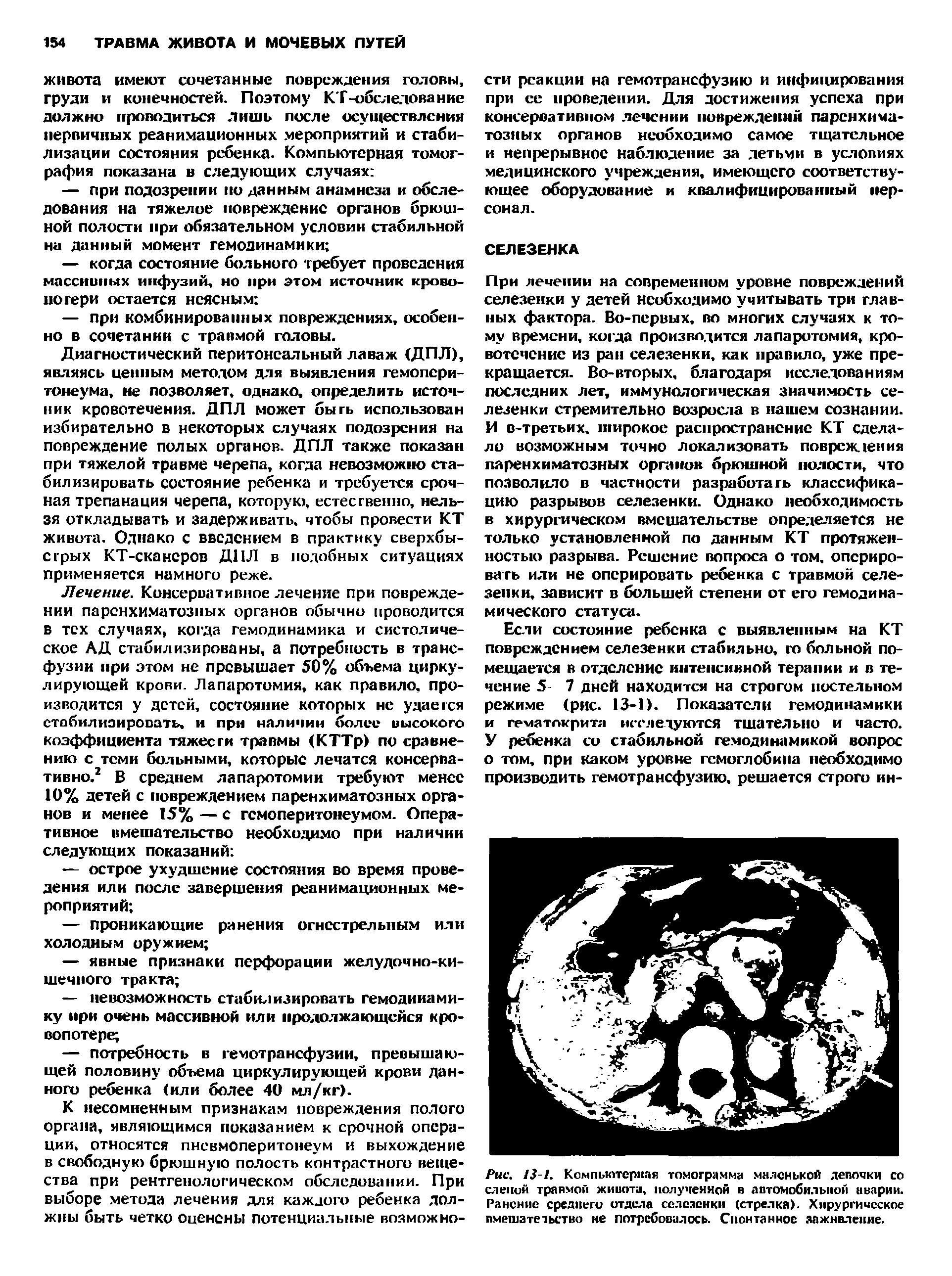 Рис. 13-1. Компьютерная томограмма маленькой лепочки со слепой травмой живота, полученной в автомобильной аварии. Ранение среднего отдела селезенки (стрелка). Хирургическое вмешательство не потребовалось. Спонтанное заживление.