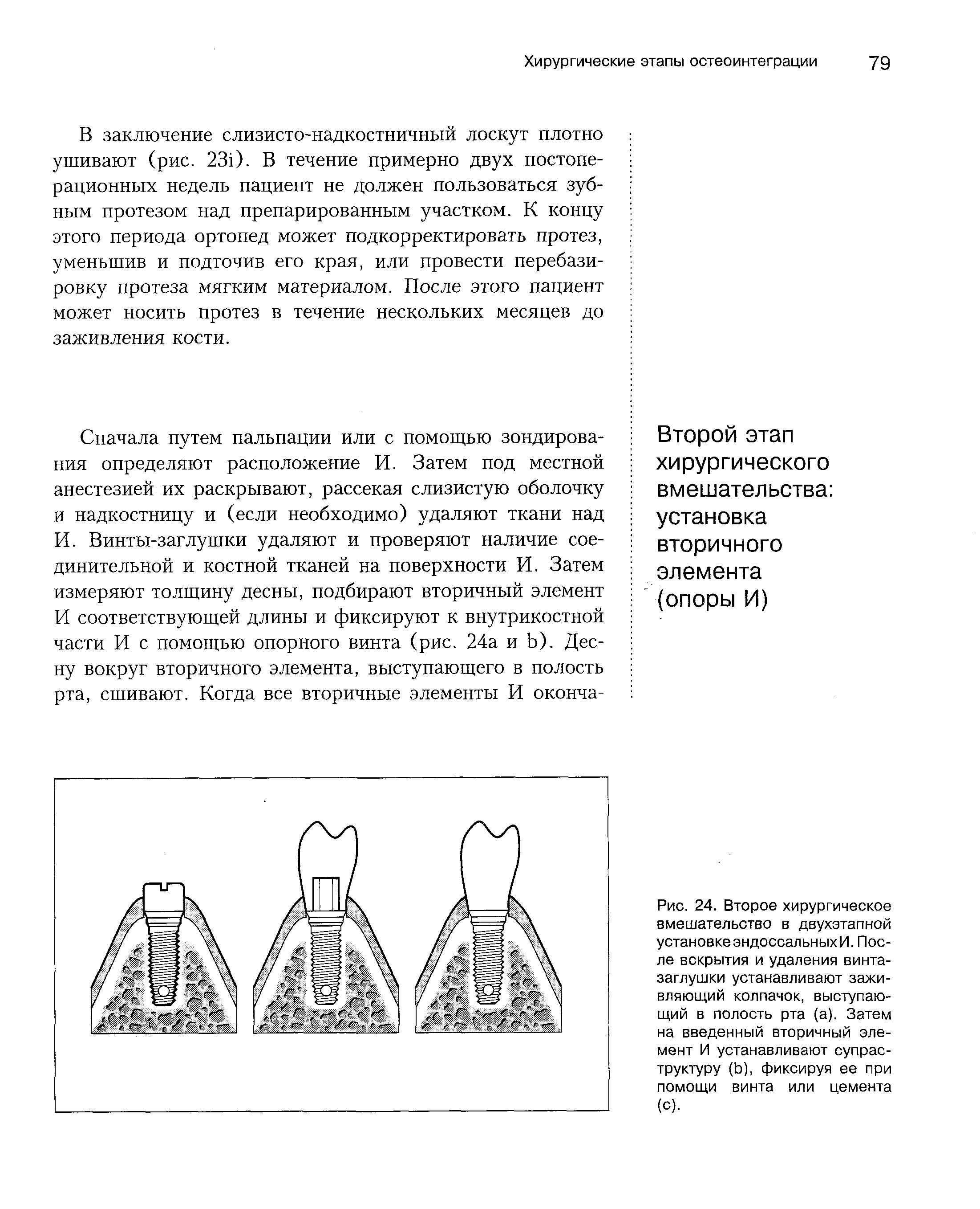 Рис. 24. Второе хирургическое вмешательство в двухэтапной установкеэндоссальныхИ. После вскрытия и удаления винта-заглушки устанавливают заживляющий колпачок, выступающий в полость рта (а). Затем на введенный вторичный элемент И устанавливают супраструктуру (Ь), фиксируя ее при помощи винта или цемента (с).