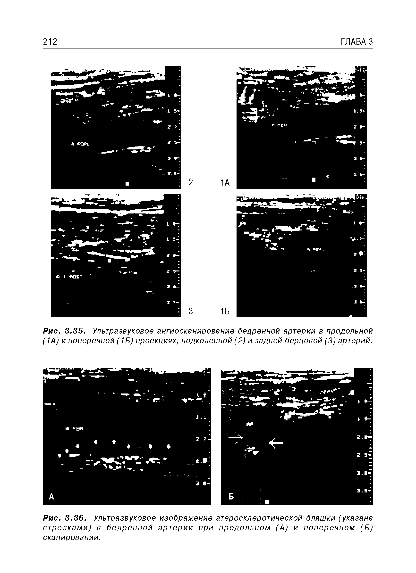 Рис. 3.36. Ультразвуковое изображение атеросклеротической бляшки (указана стрелками) в бедренной артерии при продольном (А) и поперечном (Б) сканировании.