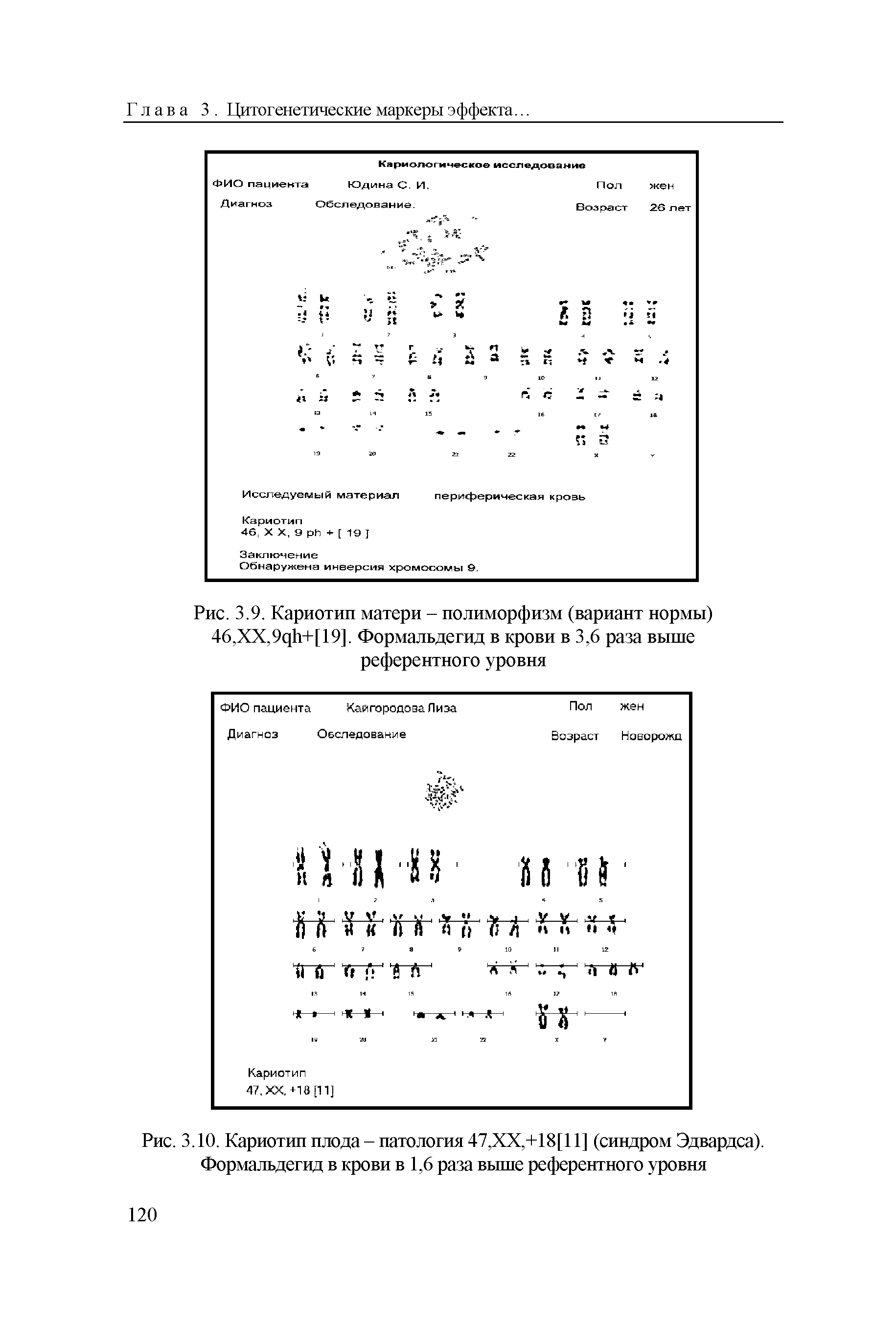 Рис. 3.9. Кариотип матери - полиморфизм (вариант нормы) 46,ХХ,9цЬ+[19]. Формальдегид в крови в 3,6 раза выше референтного уровня...