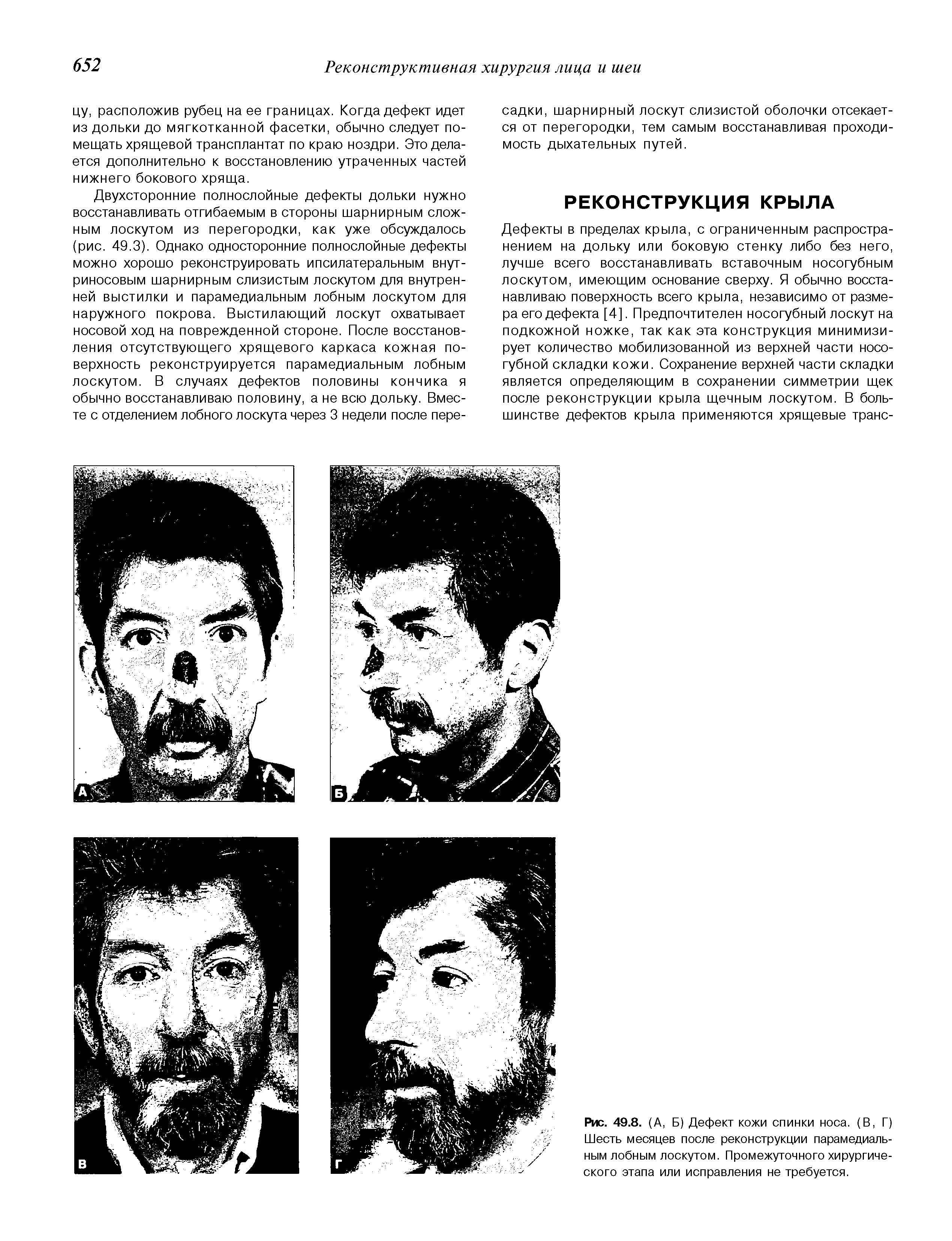 Рис. 49.8. (А, Б) Дефект кожи спинки носа. (В, Г) Шесть месяцев после реконструкции парамедиальным лобным лоскутом. Промежуточного хирургического этапа или исправления не требуется.