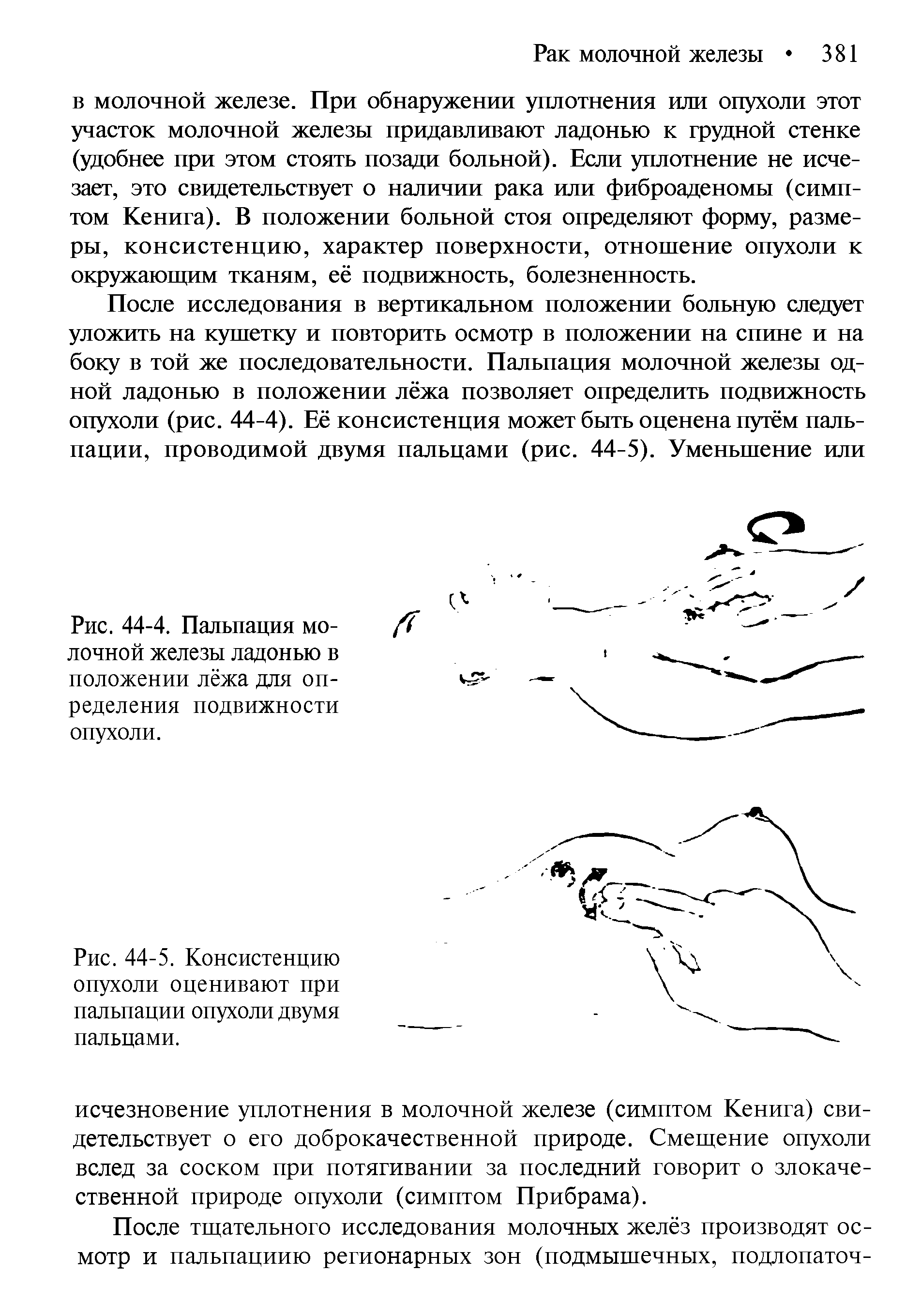 Рис. 44-5. Консистенцию опухоли оценивают при пальпации опухоли двумя пальцами.