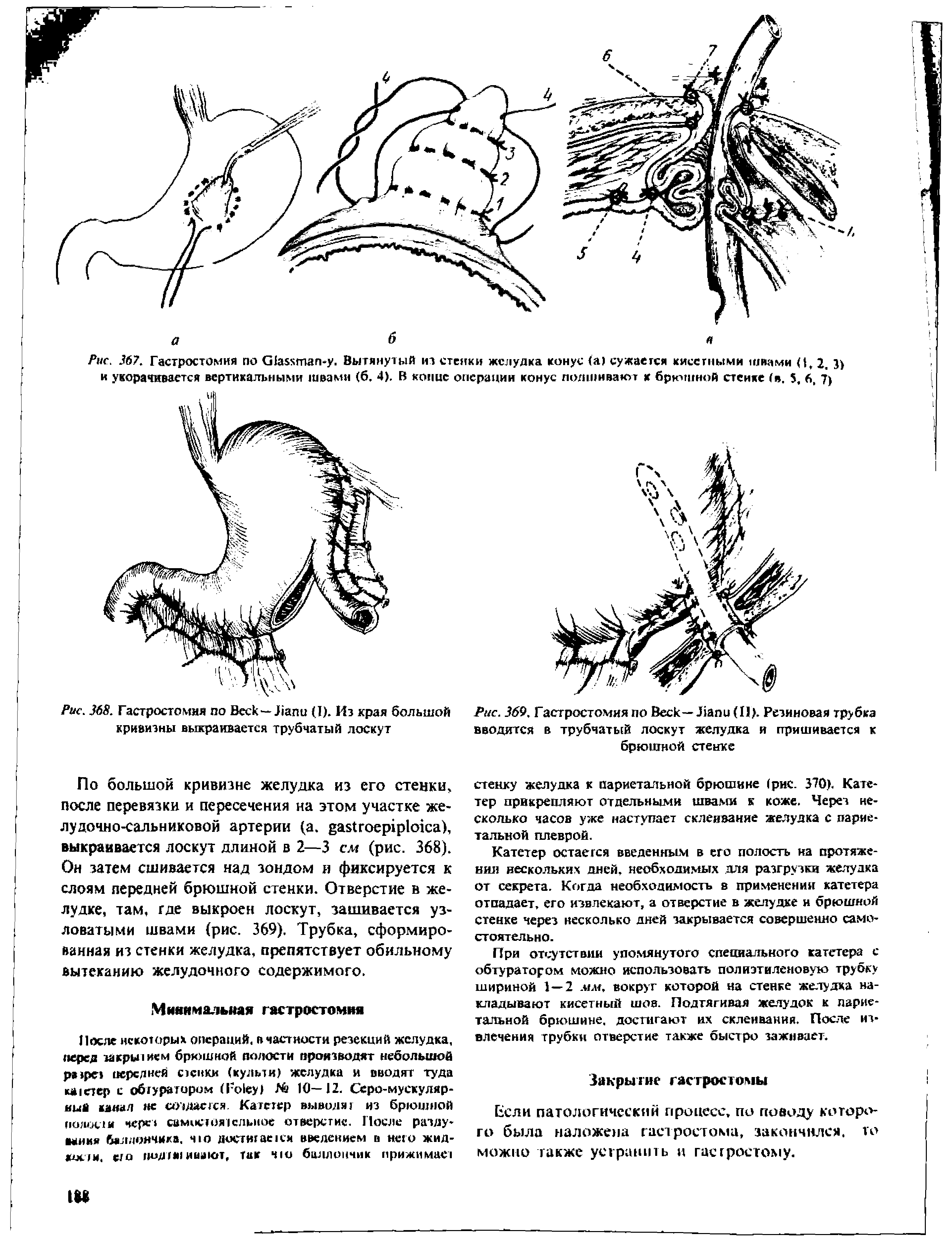 Рис. 369, Гастростомия по Веек— Лапи(П). Резиновая трубка вводится в трубчатый лоскут желудка и пришивается к брюшной стейке...