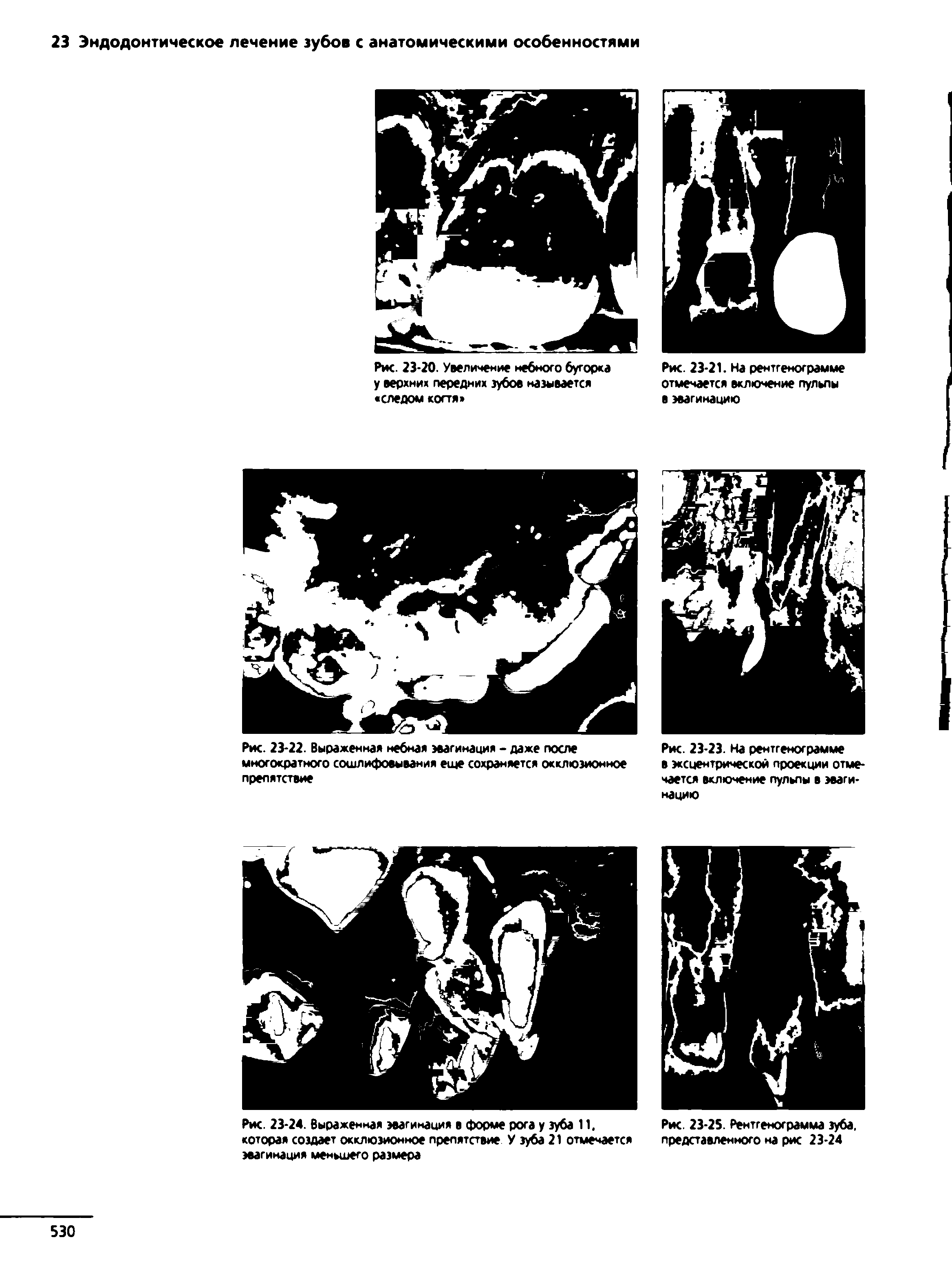 Рис. 23-24. Выраженная эвагинация в форме рога у зуба 11. которая создает окклюзионное препятствие У зуба 21 отмечается эвагинация меньшего размера...