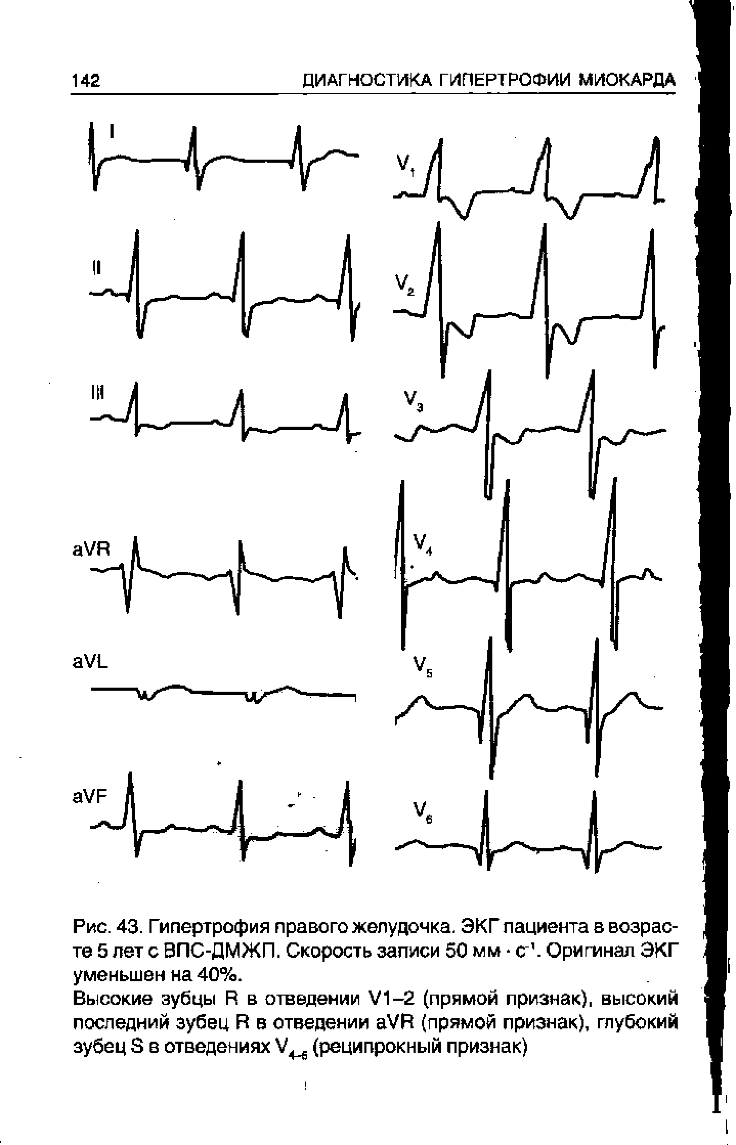 Рис. 43. Гипертрофия правого желудочка. ЭКГ пациента в возрасте 5 лет с ВПС-ДМЖП. Скорость записи 50 мм с . Оригинал ЭКГ уменьшен на 40%.
