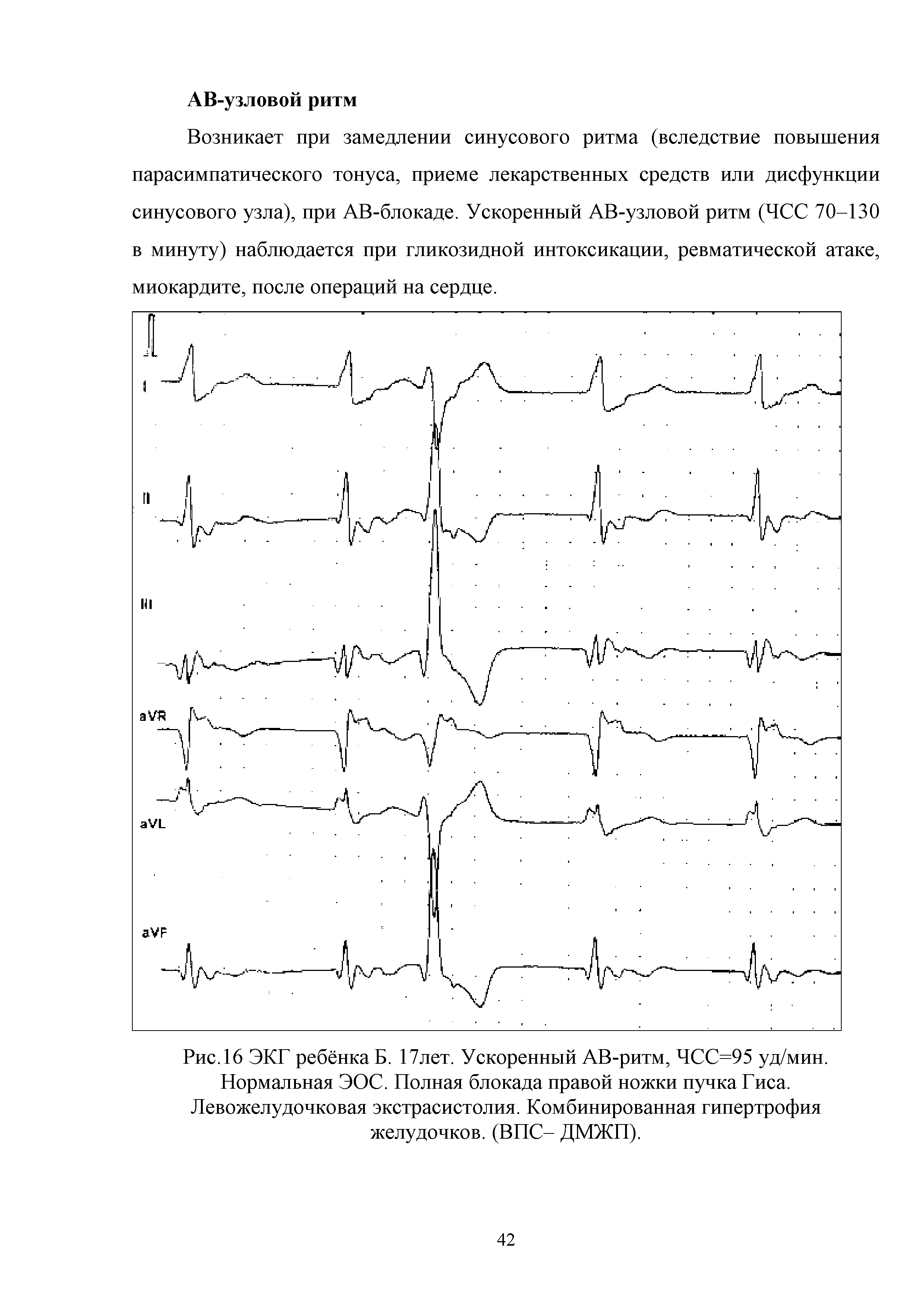 Рис. 16 ЭКГ ребёнка Б. 17лет. Ускоренный АВ-ритм, ЧСС=95 уд/мин. Нормальная ЭОС. Полная блокада правой ножки пучка Гиса. Левожелудочковая экстрасистолия. Комбинированная гипертрофия желудочков. (ВПС- ДМЖП).