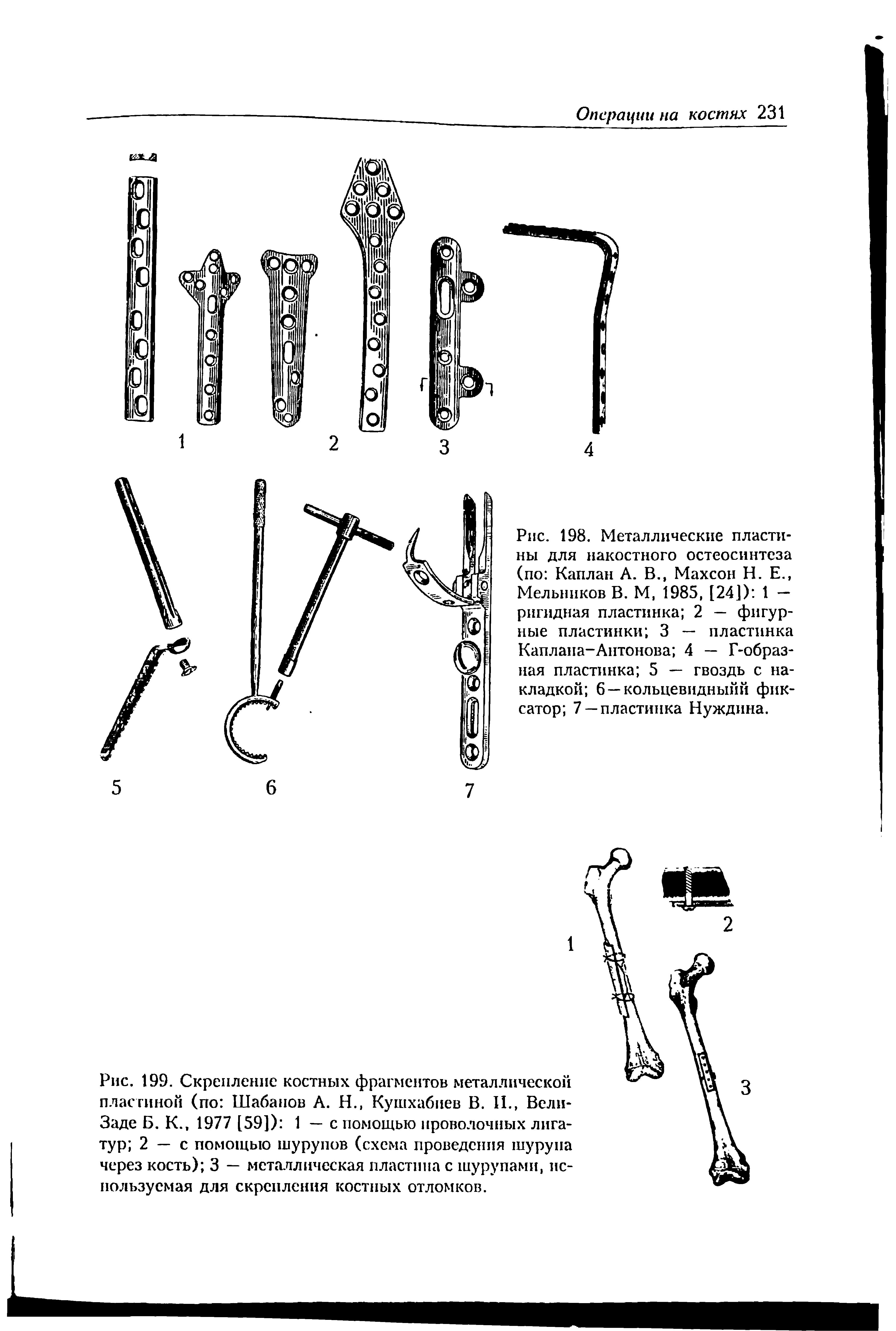 Рис. 198. Металлические пластины для накостного остеосинтеза (по Каплан А. В. Махсон Н. Е. Мельников В. М, 1985, [24]) 1 — ригидная пластинка 2 — фигурные пластинки 3 — пластинка Каплана-Антонова 4 — Г-образ-ная пластинка 5 — гвоздь с накладкой 6 —кольцевидныйй фиксатор 7 —пластинка Нуждина.