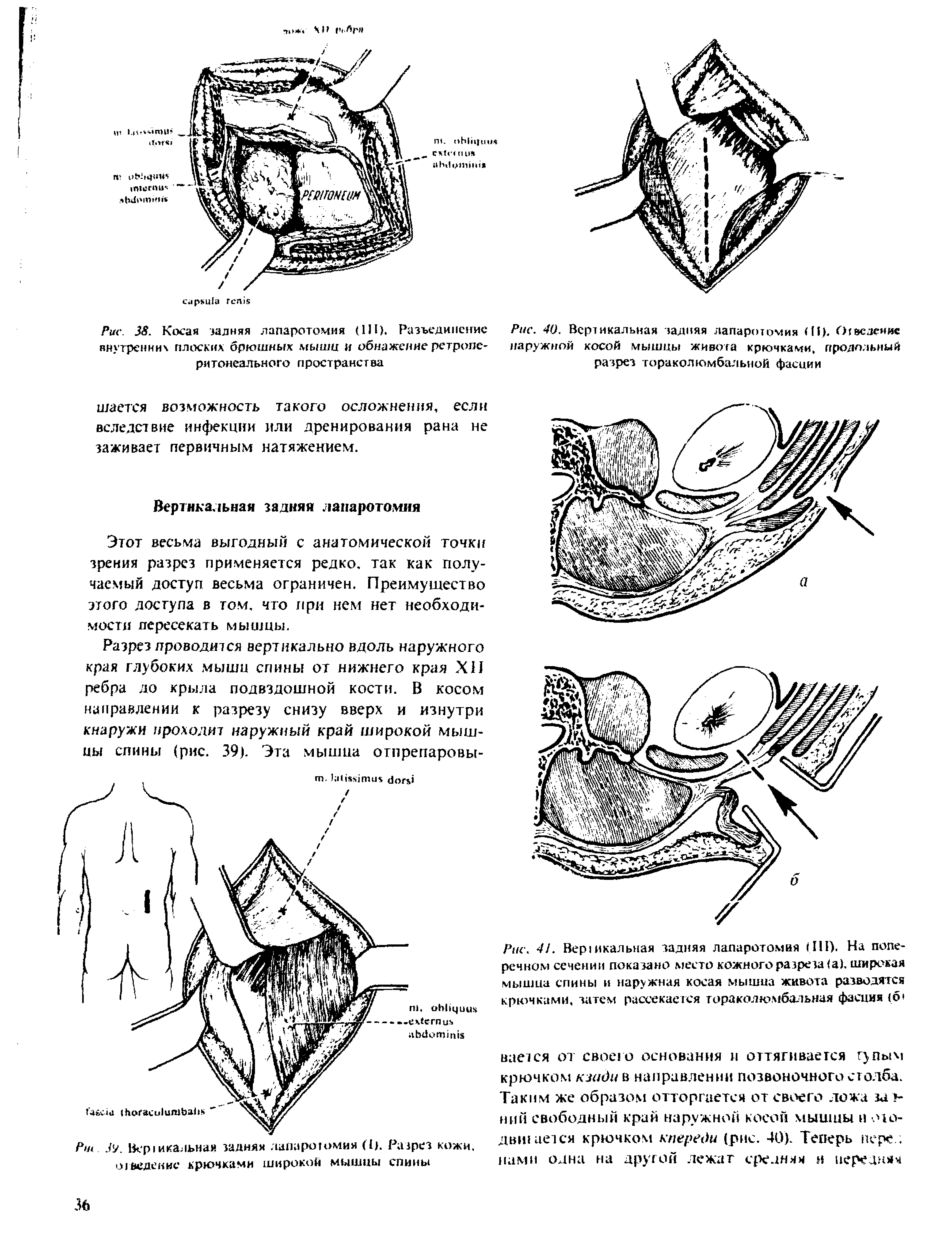 Рис. 38. Косая задняя лапаротомия (III). Разъединение внутренних плоских брюшных мышц и обнажение ретроперитонеального пространства...