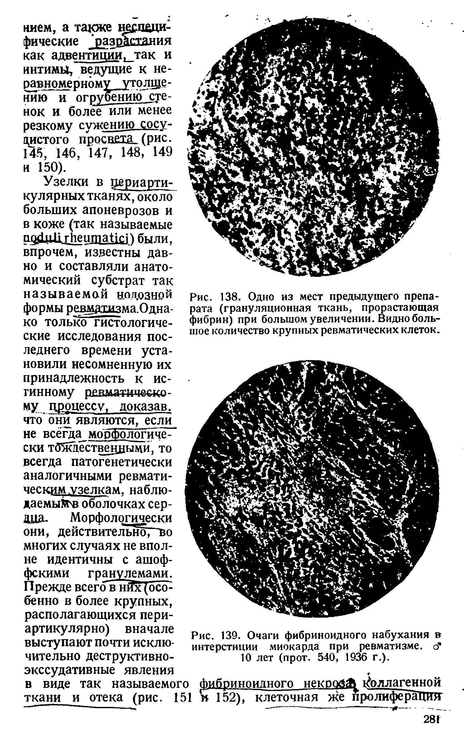 Рис. 139. Очаги фибриноидного набухания в интерстиции миокарда при ревматизме. сГ 10 лет (прот. 540, 1936 г.).