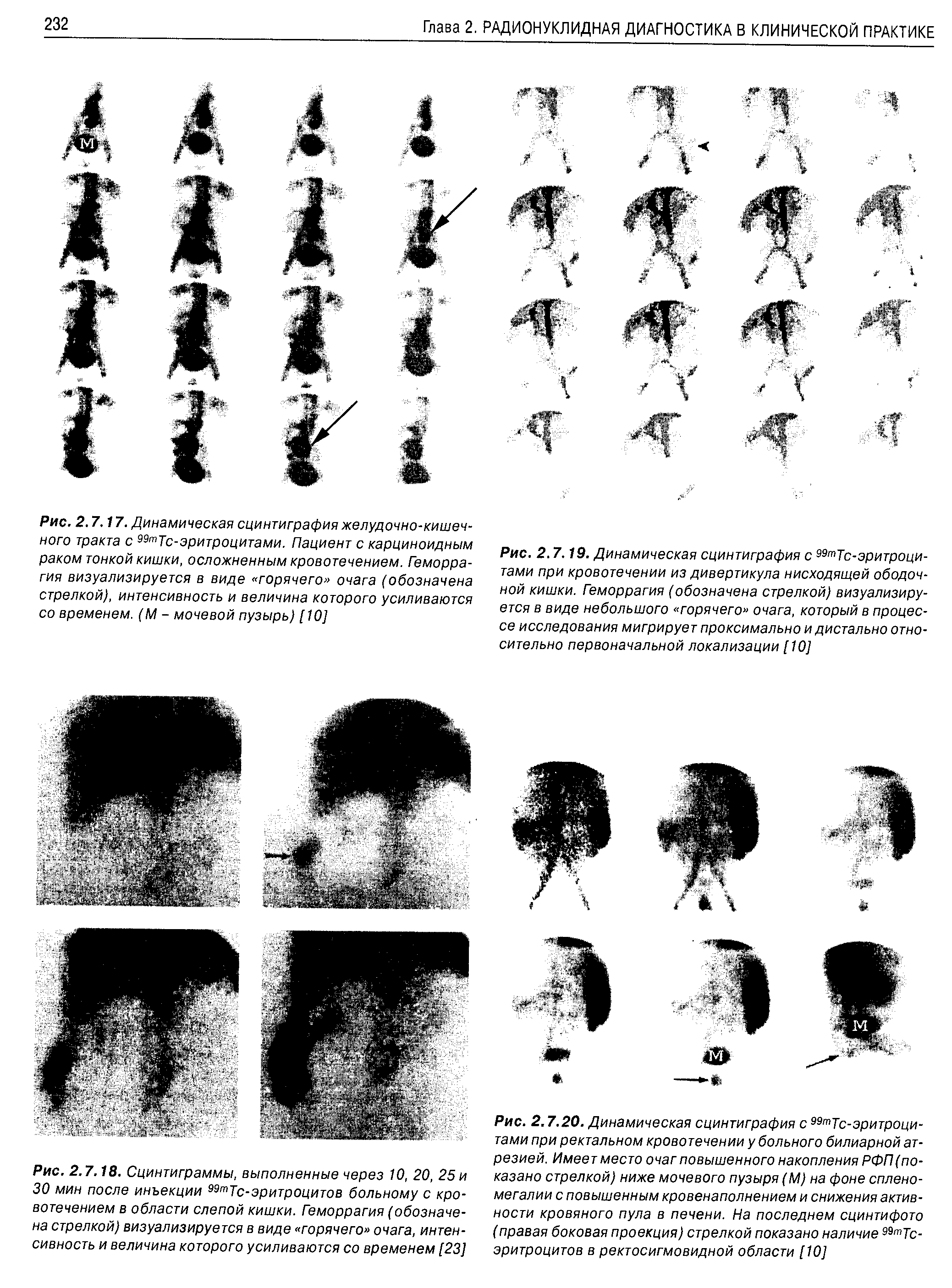 Рис. 2.7.18. Сцинтиграммы, выполненные через 10, 20, 25 и 30 мин после инъекции 99тТс-эритроцитов больному с кровотечением в области слепой кишки. Геморрагия (обозначена стрелкой) визуализируется в виде горячего очага, интенсивность и величина которого усиливаются со временем [23]...