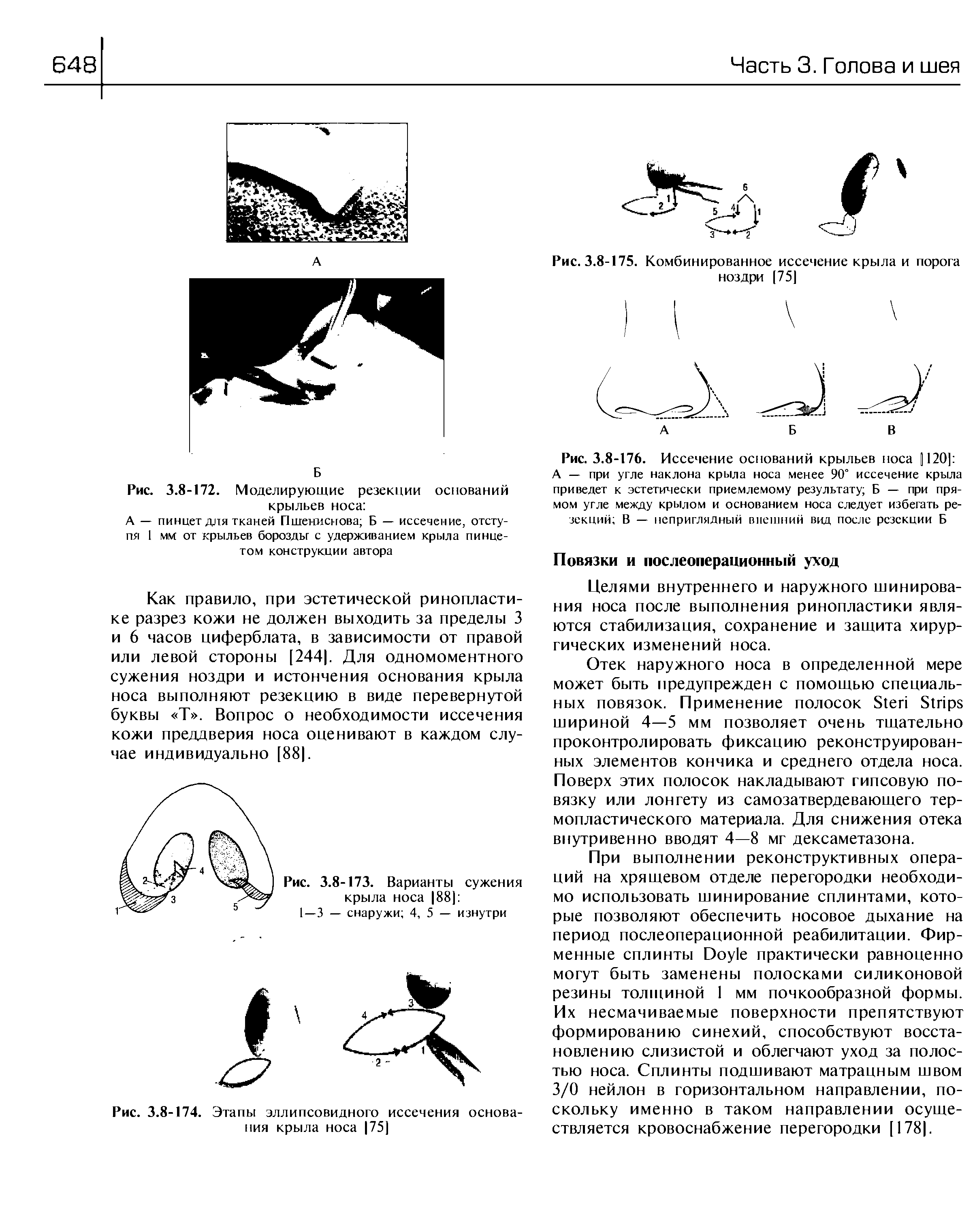 Рис. 3.8-176. Иссечение оснований крыльев носа 1120] А — при угле наклона крыла носа менее 90 иссечение крыла приведет к эстетически приемлемому результату Б — при прямом угле между крылом и основанием носа следует избегать резекций В — неприглядный внешний вид после резекции Б...
